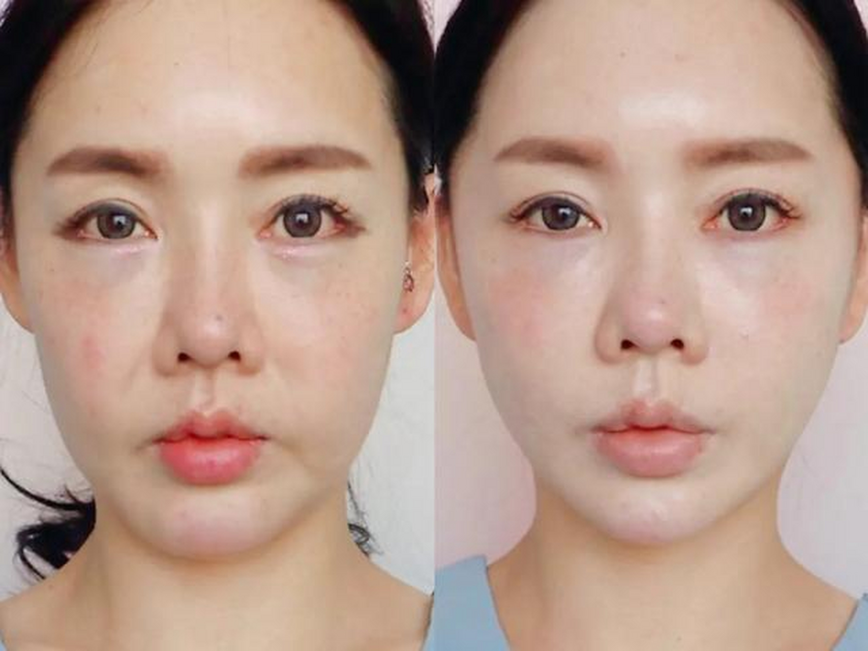 苹果肌复位,一个小切口能改善眼袋,泪沟,面部松弛,法令纹,这么划算的