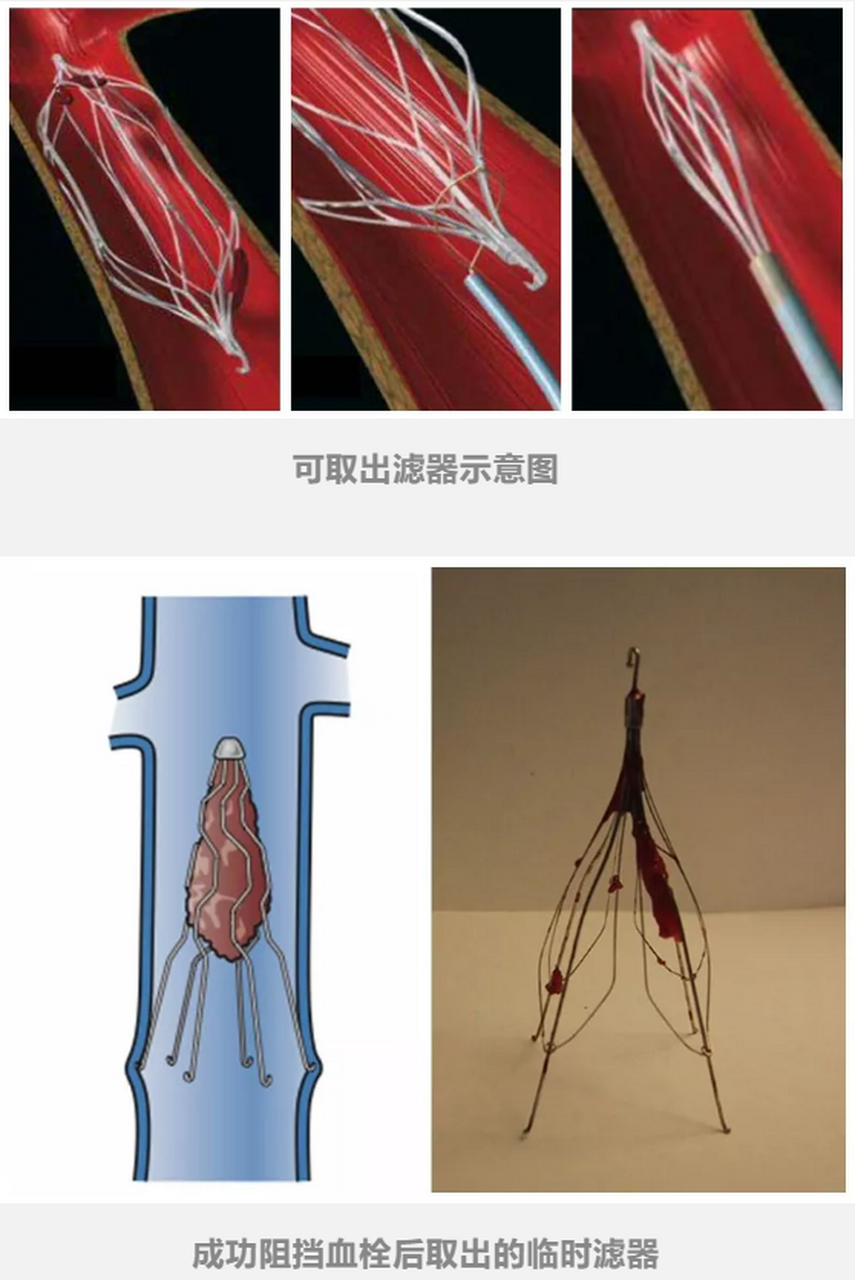 肺栓塞滤器图片