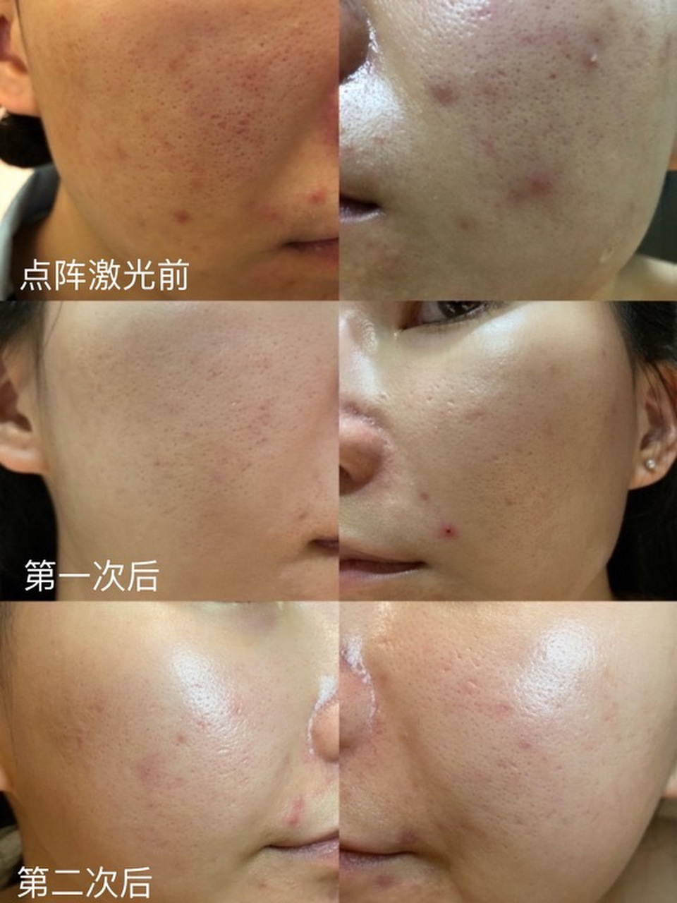 点阵激光祛痘印几次才有效果?