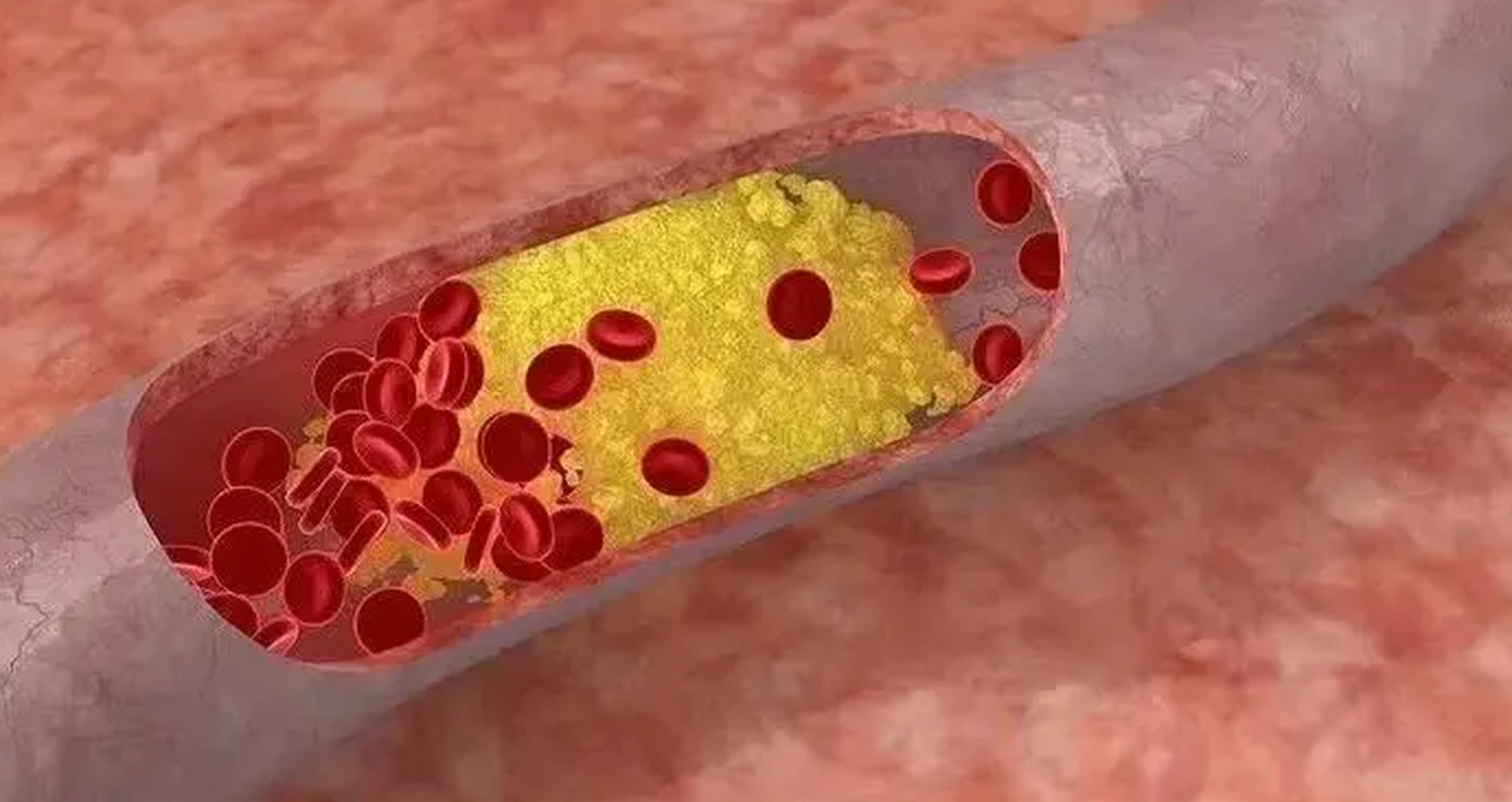 高血脂是危害人体心脑血管健康的一大杀手,人体一旦血脂过高,不加以