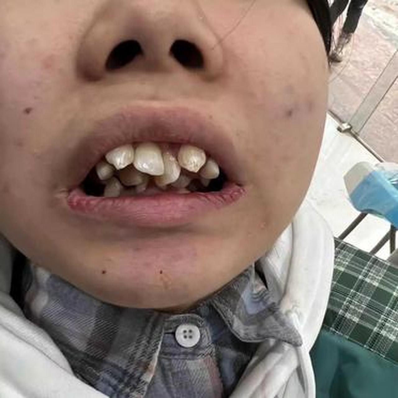 孩子的牙齿长成这样,和父母有一定的关系