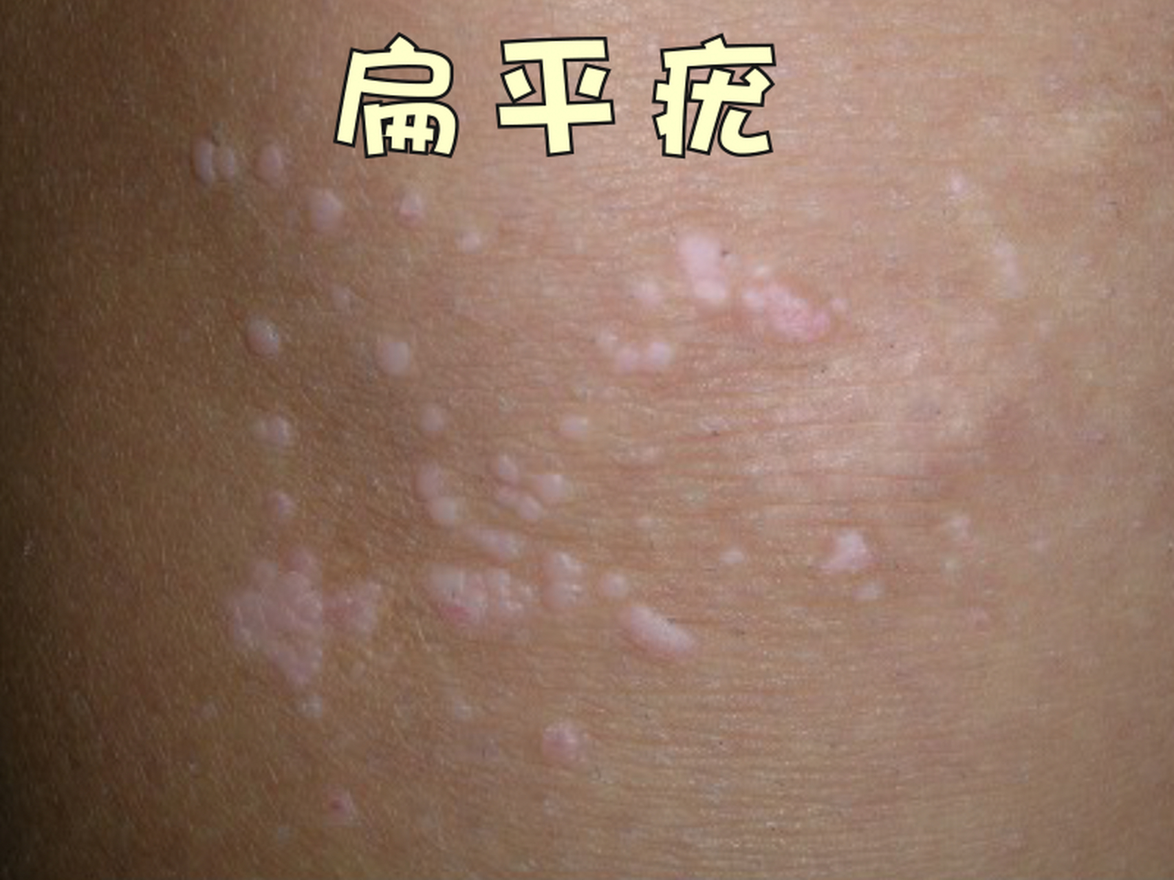 扁平疣,俗称为"扁瘊",是由人乳头状瘤病毒
