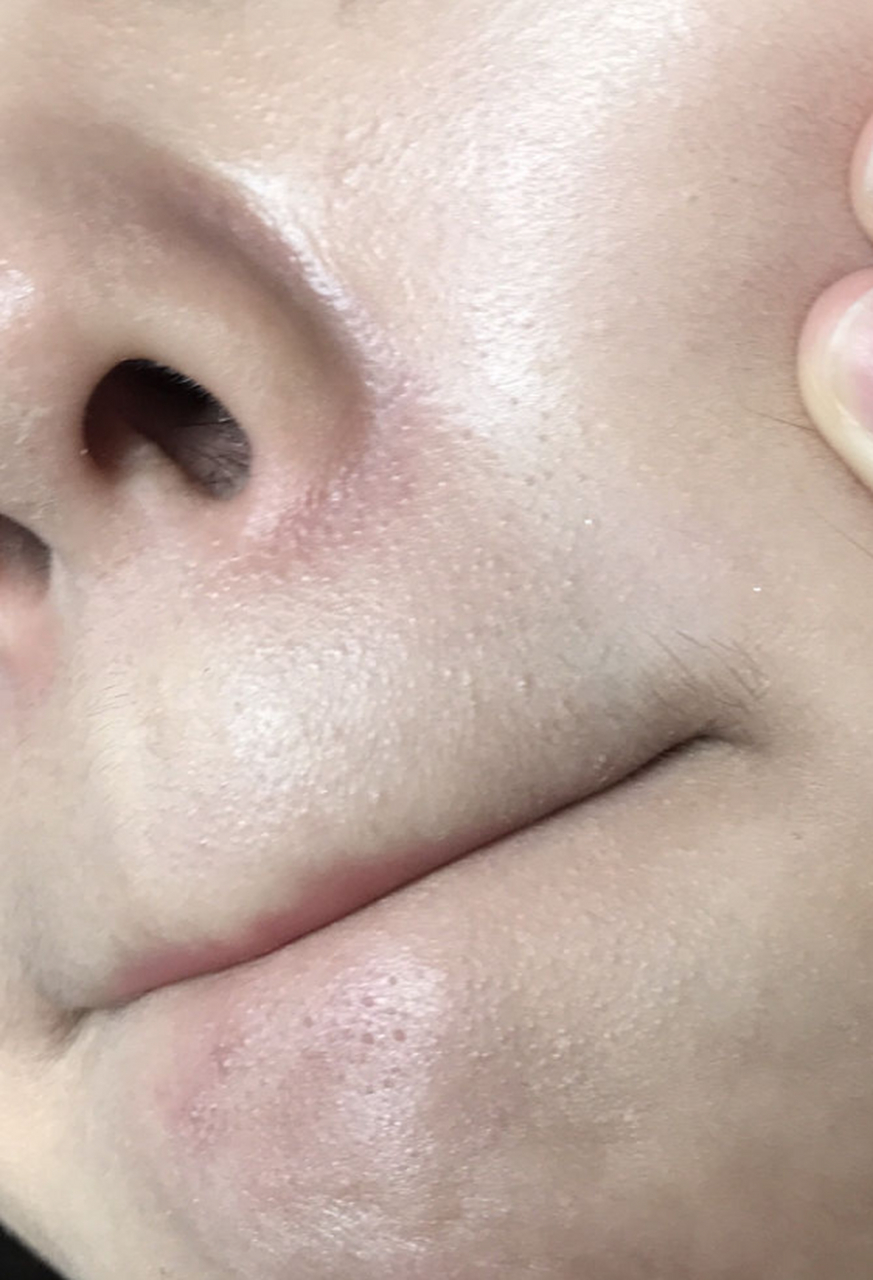 脸上长很多小粉刺是为什么