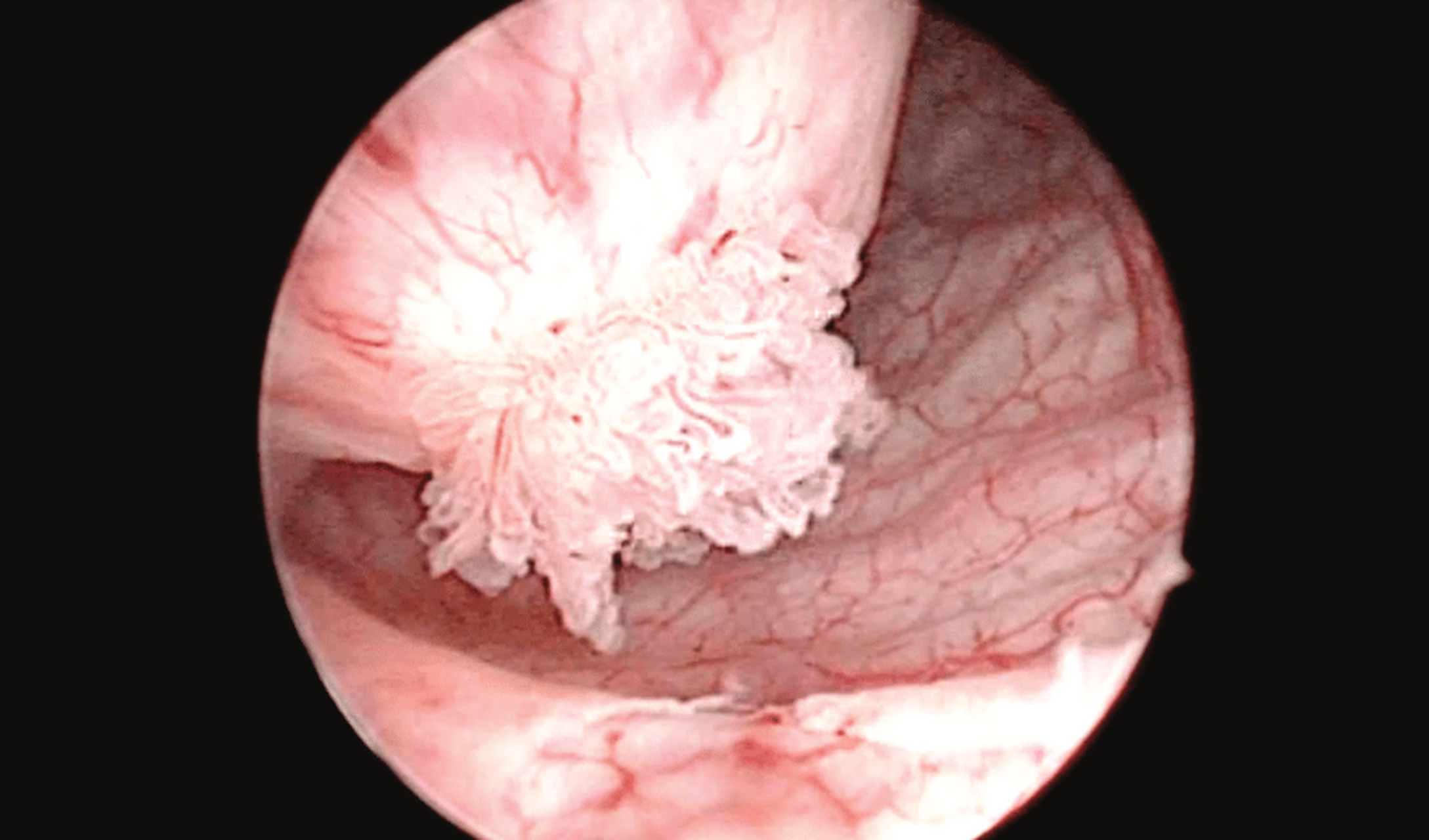朱医生告诉你 尖锐湿疣,尤其是男性尿道口的尖锐湿疣,通常发生在没有