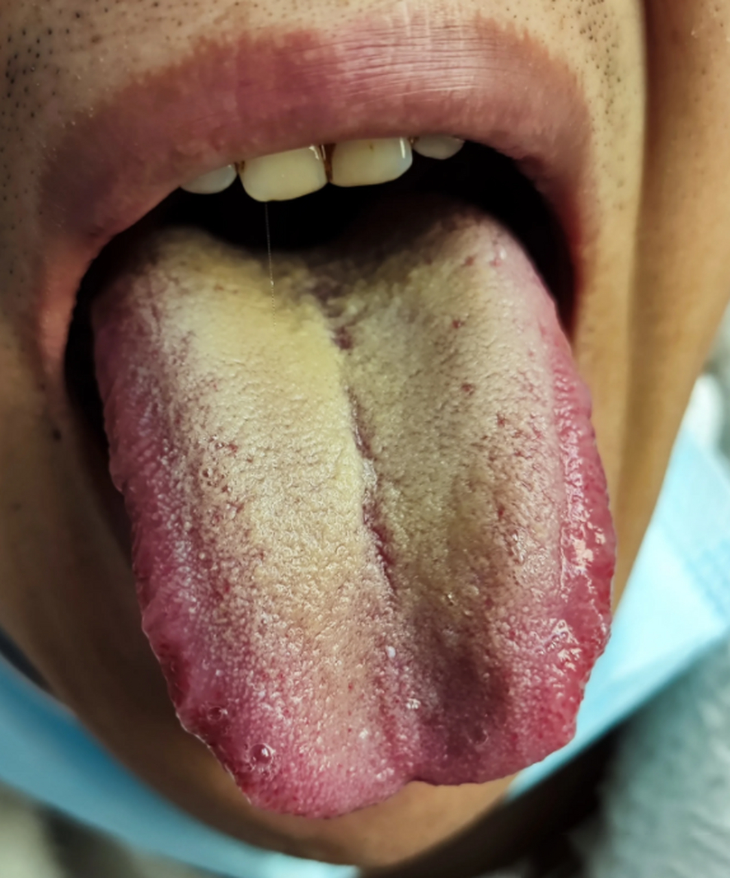 分不清楚寒和热,来看看这个两个舌头,寒热一眼可判  通常情况下舌质红