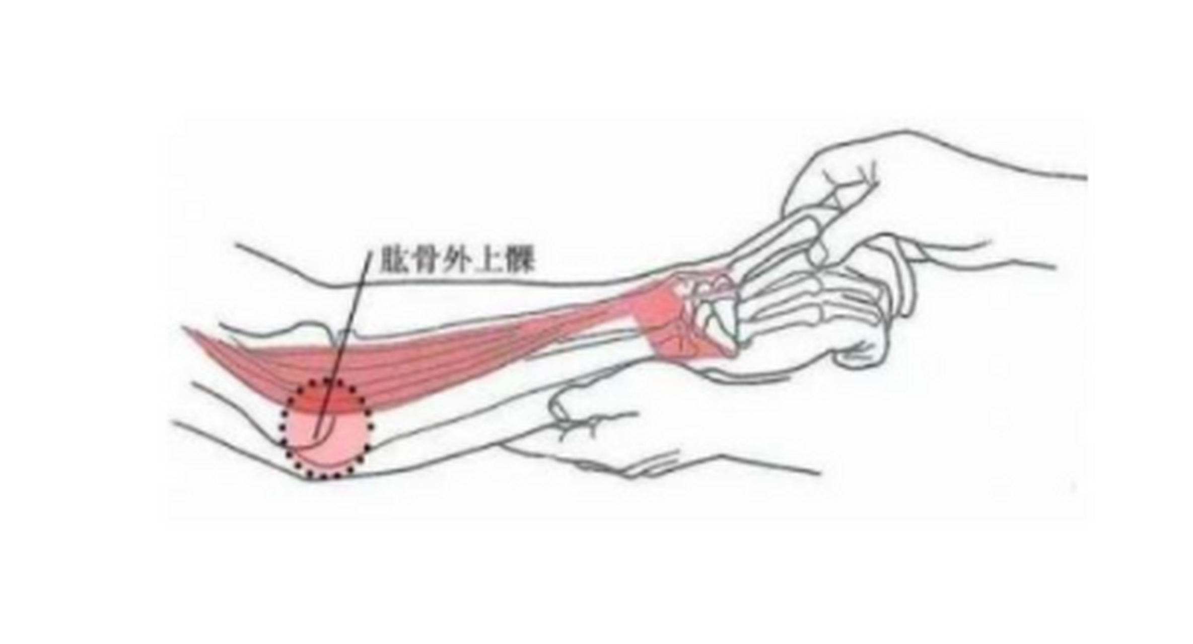 肱骨外上髁炎位置图片图片