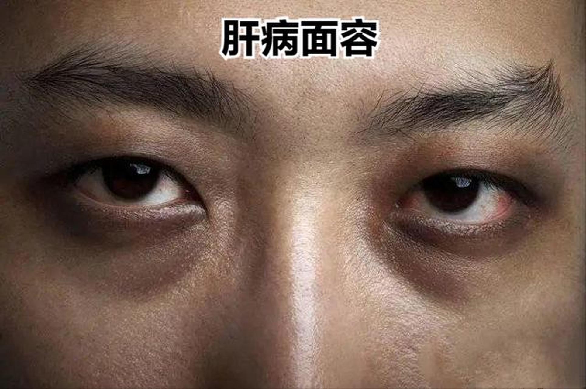 肝病面容 表现为面部晦暗无光泽,皮肤发黄,发黑,尤以眼眶周围更为