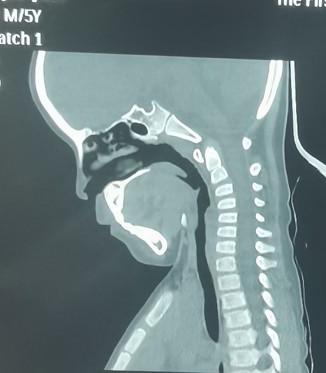 很难想象这是一个5岁的孩子颈椎,电子产品的毒害,颈椎反弓严重!
