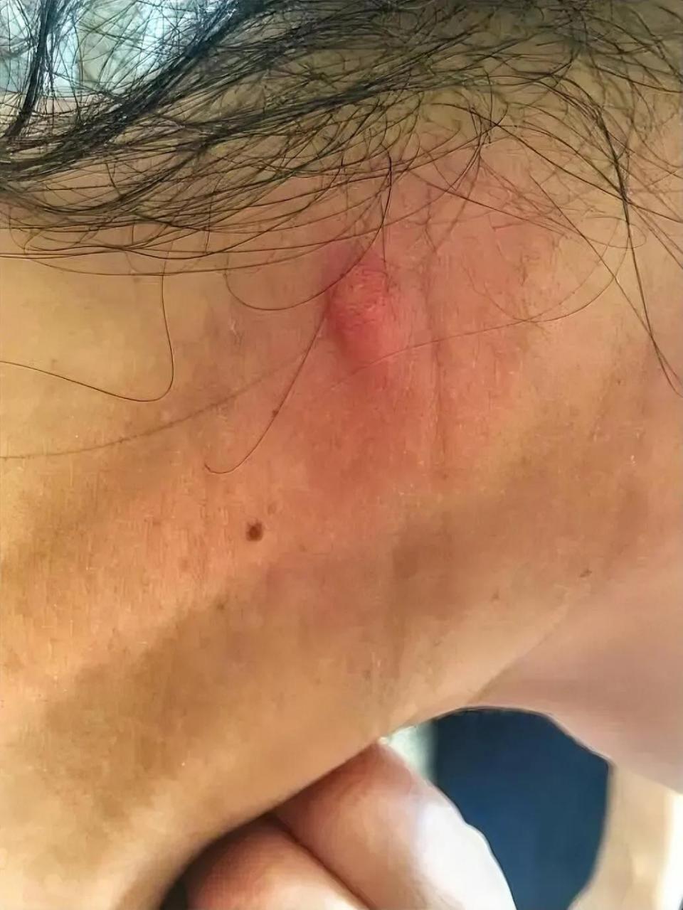 在农村池塘河湖里游泳后常常会遭遇牛虻的叮咬