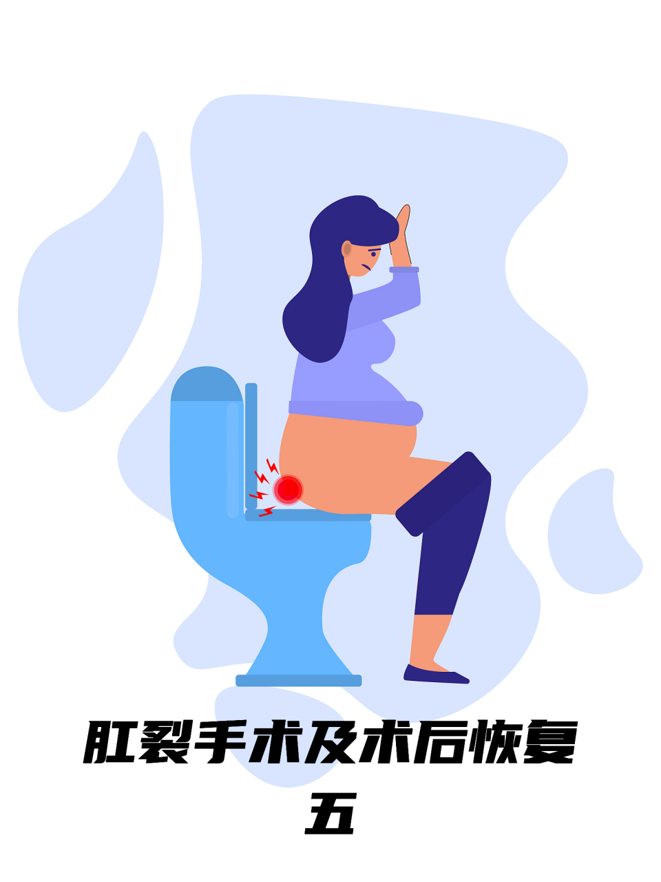 肛裂手术及术后恢复(五)#肛裂# 5月1日,术后19天整,去医院复诊了,医生