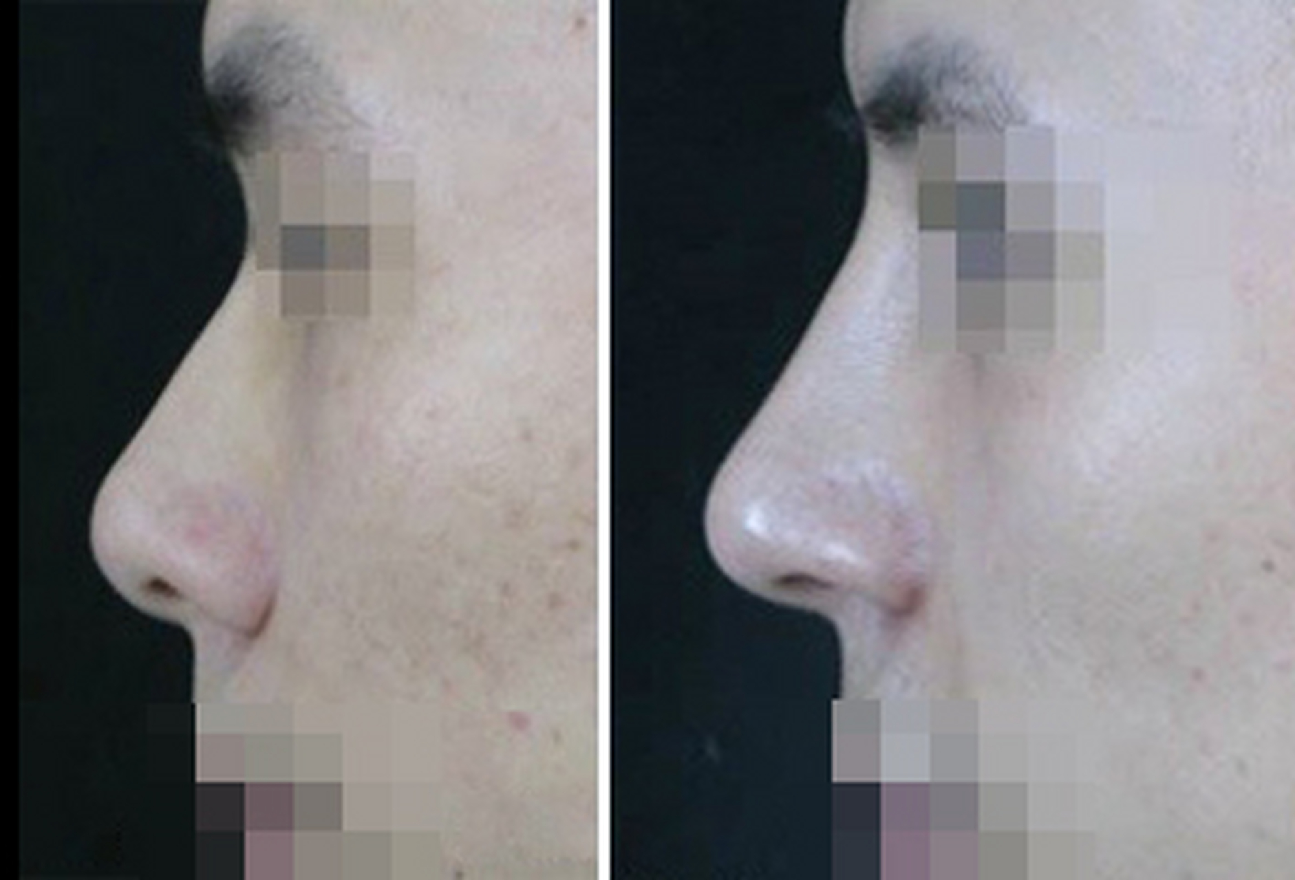 没有鼻头(过于圆钝),鼻尖表现点偏上,会导致鼻孔暴露过多,给人鲁钝