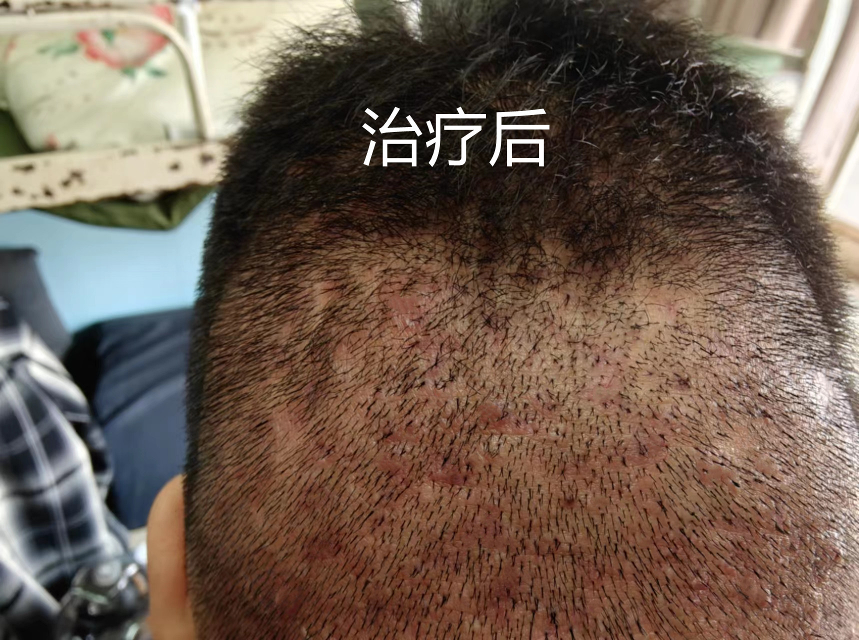 "后脑勺毛囊炎,中医调理成功!