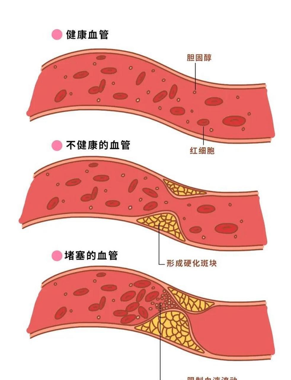 动脉粥样硬化红蓝图图片