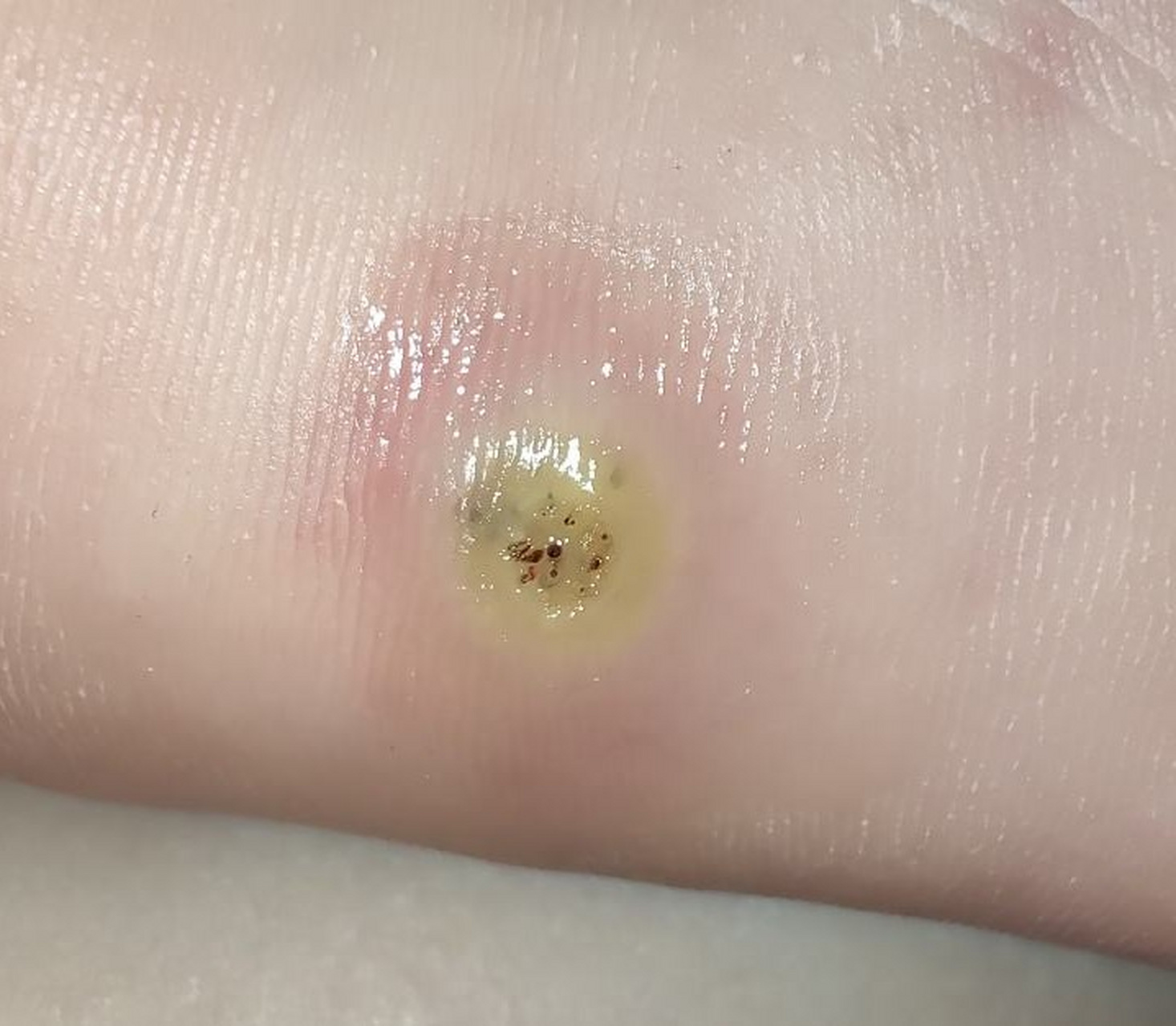 跖疣是感染了hpv病毒吗?