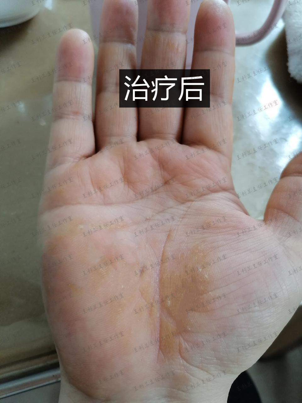 有手湿疹的朋友,不用再拖了!