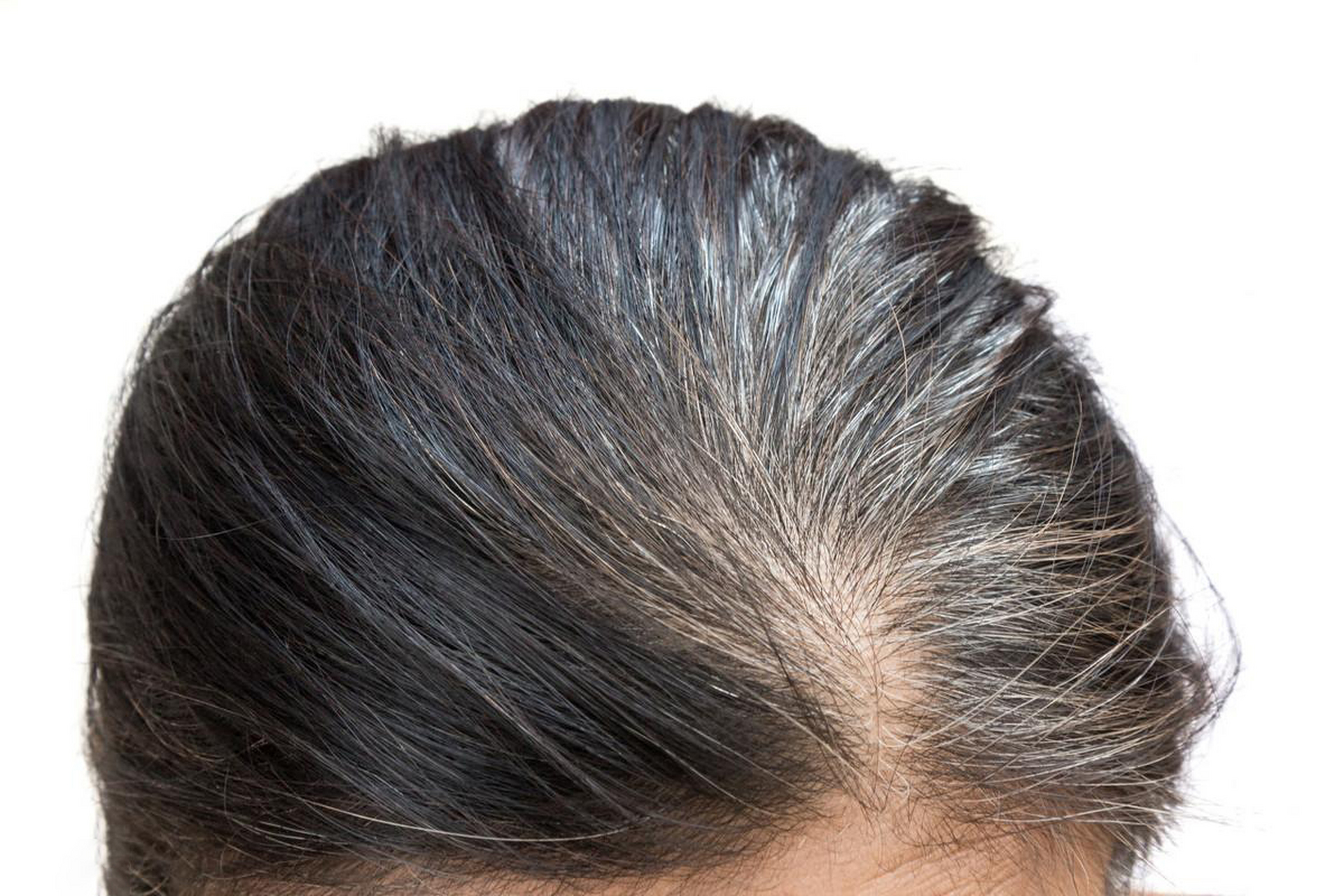 引起白发的原因有很多,不能一概而论,应根据自身情况对症治疗;  如果