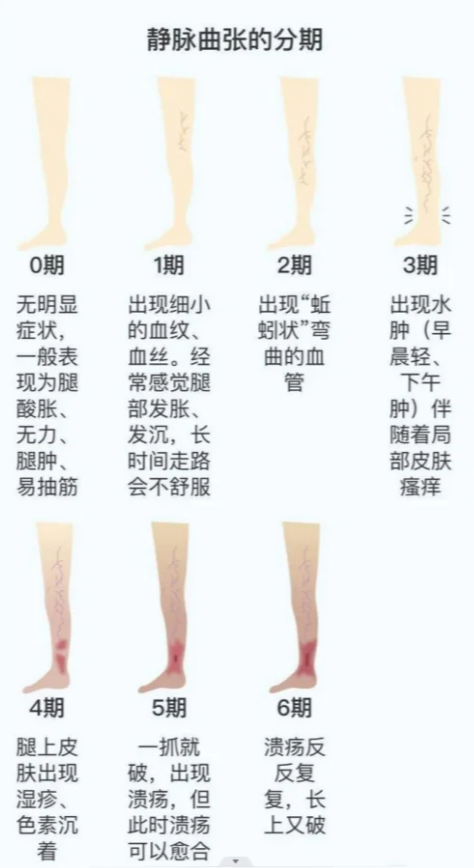 静脉曲张的分期 0期:无明显症状,一般表现为腿酸胀,无力,腿肿,易抽筋