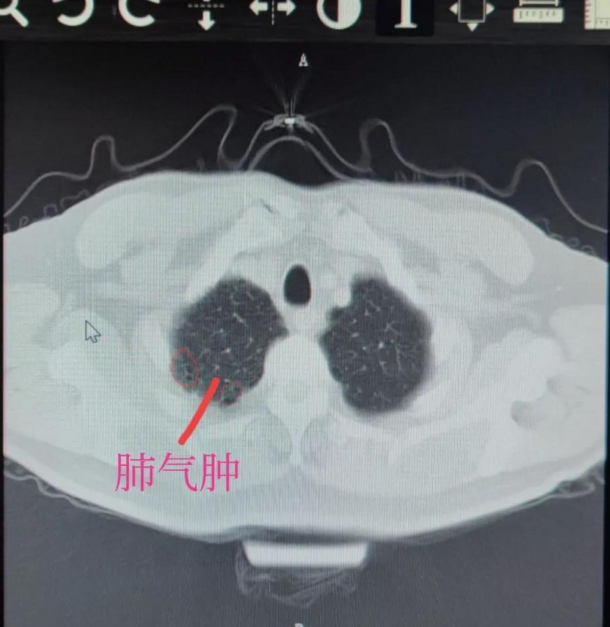 烟龄40多年,每天不到一包,不咳不喘,极轻度的慢支肺气肿患者的肺ct#给