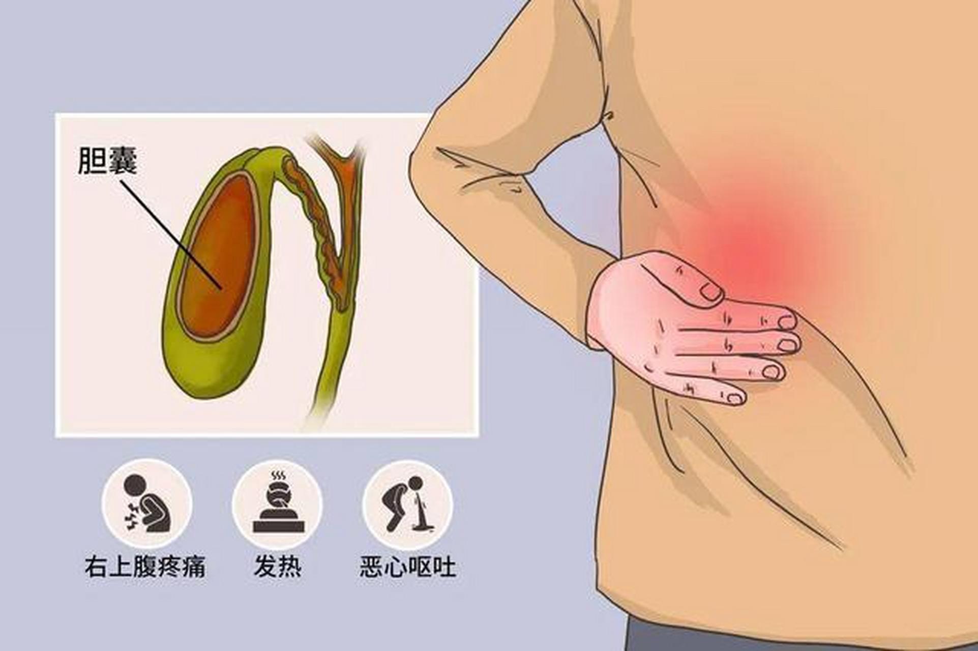 急性胆囊炎的发生与胆囊结石关系紧密,临床上大部分胆囊炎都是由结石