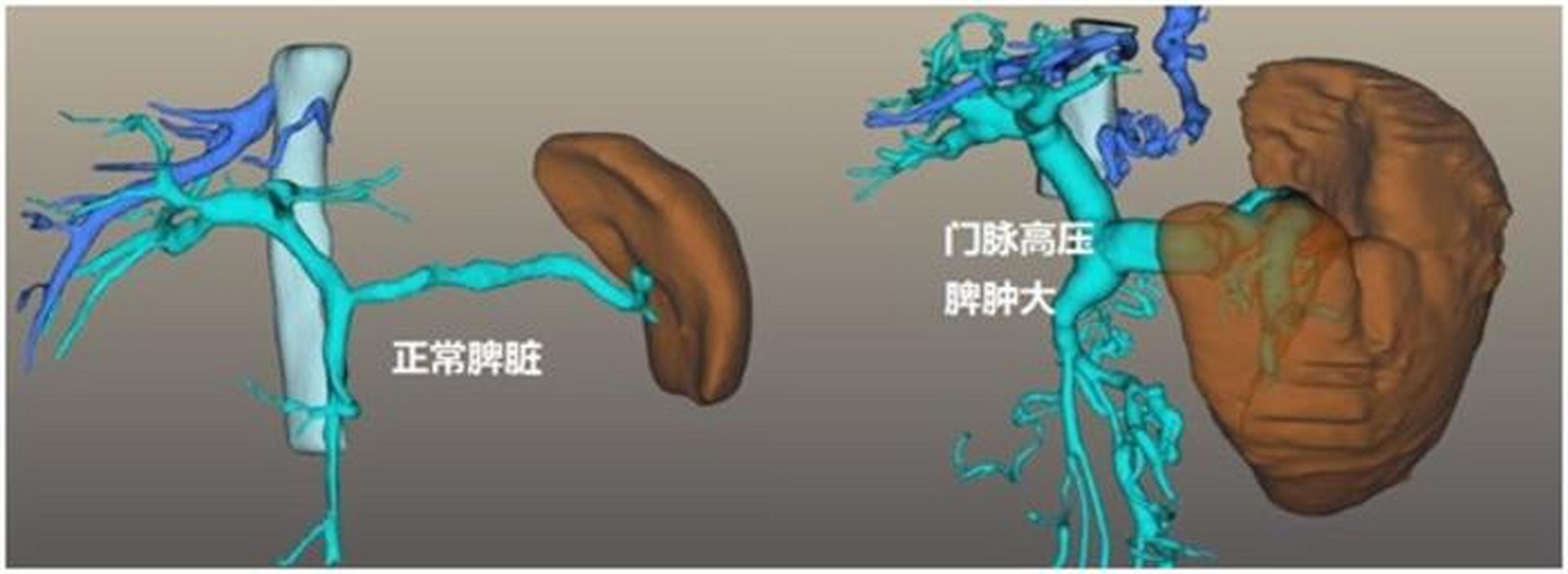 山东陈主任回复:门脉高压是可以处理的,在早期可以用药物