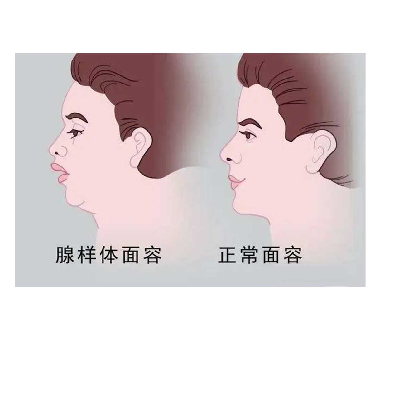 孩子长期张口呼吸小心腺样体面容.