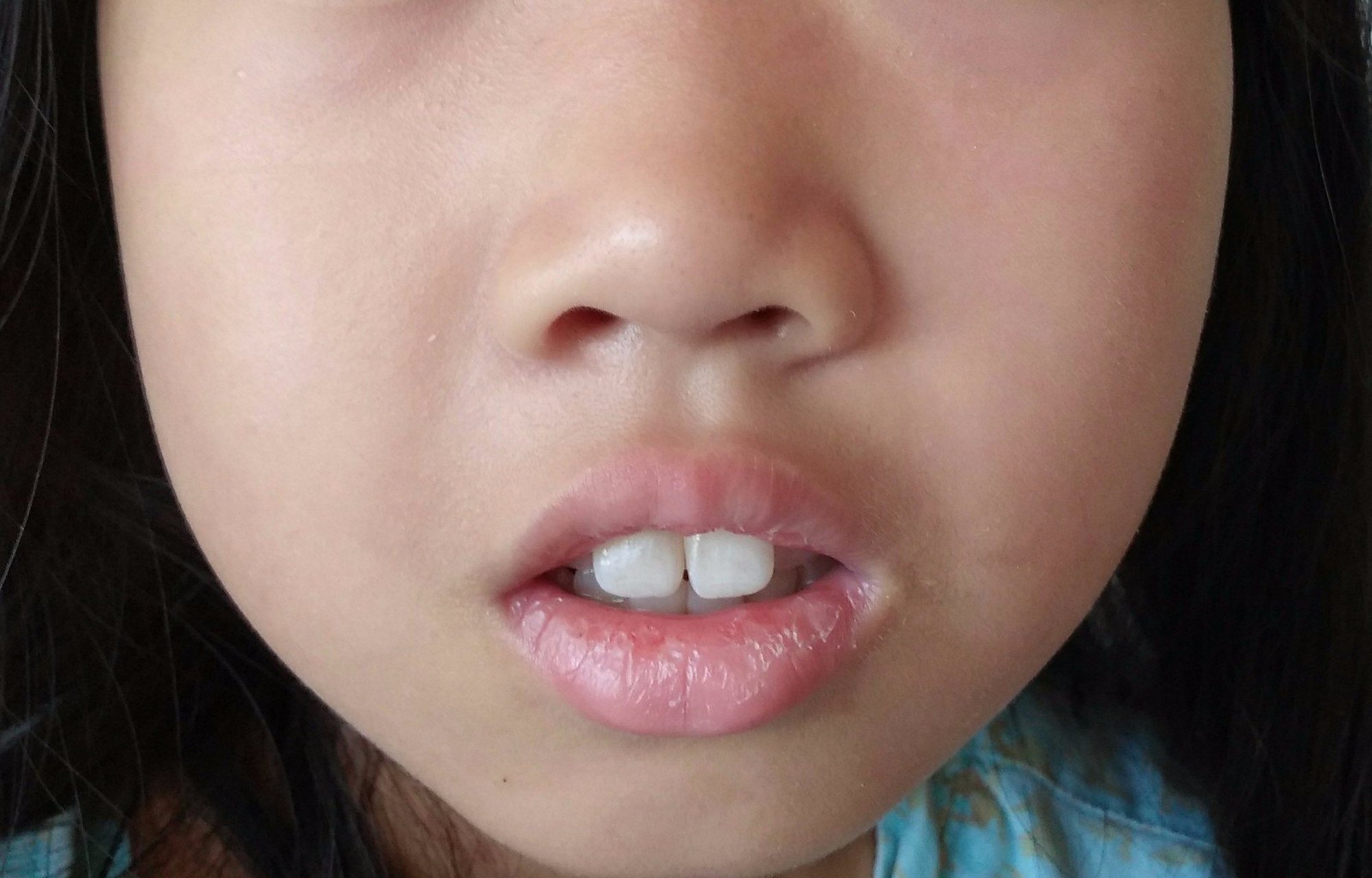 90%; 2,有睡眠呼吸暂停,慢性鼻塞,习惯性张口呼吸的问题; 3,导致鼻炎