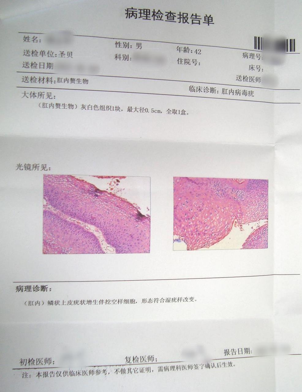 肛内尖锐湿犹图片