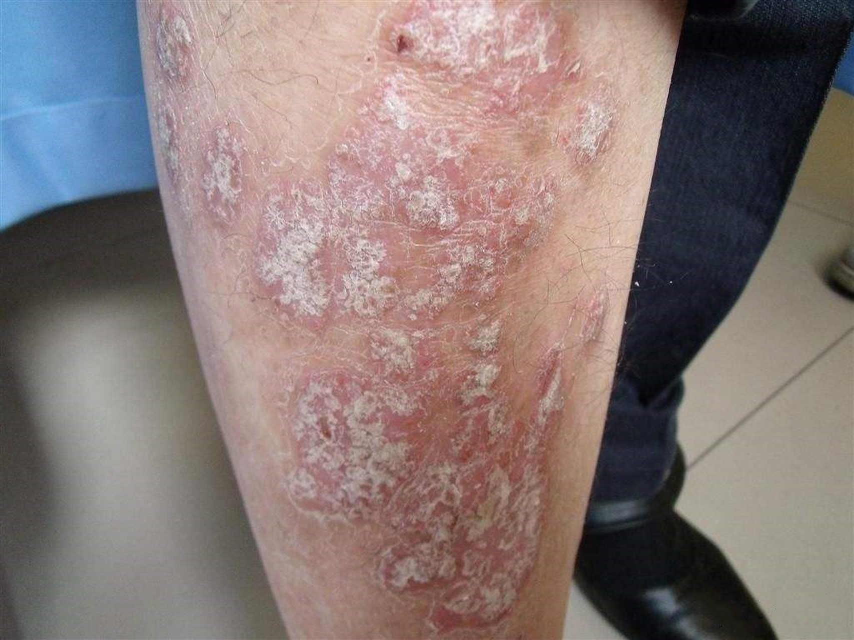 他生病已经有两年了,期间用过很多药,发病的时候