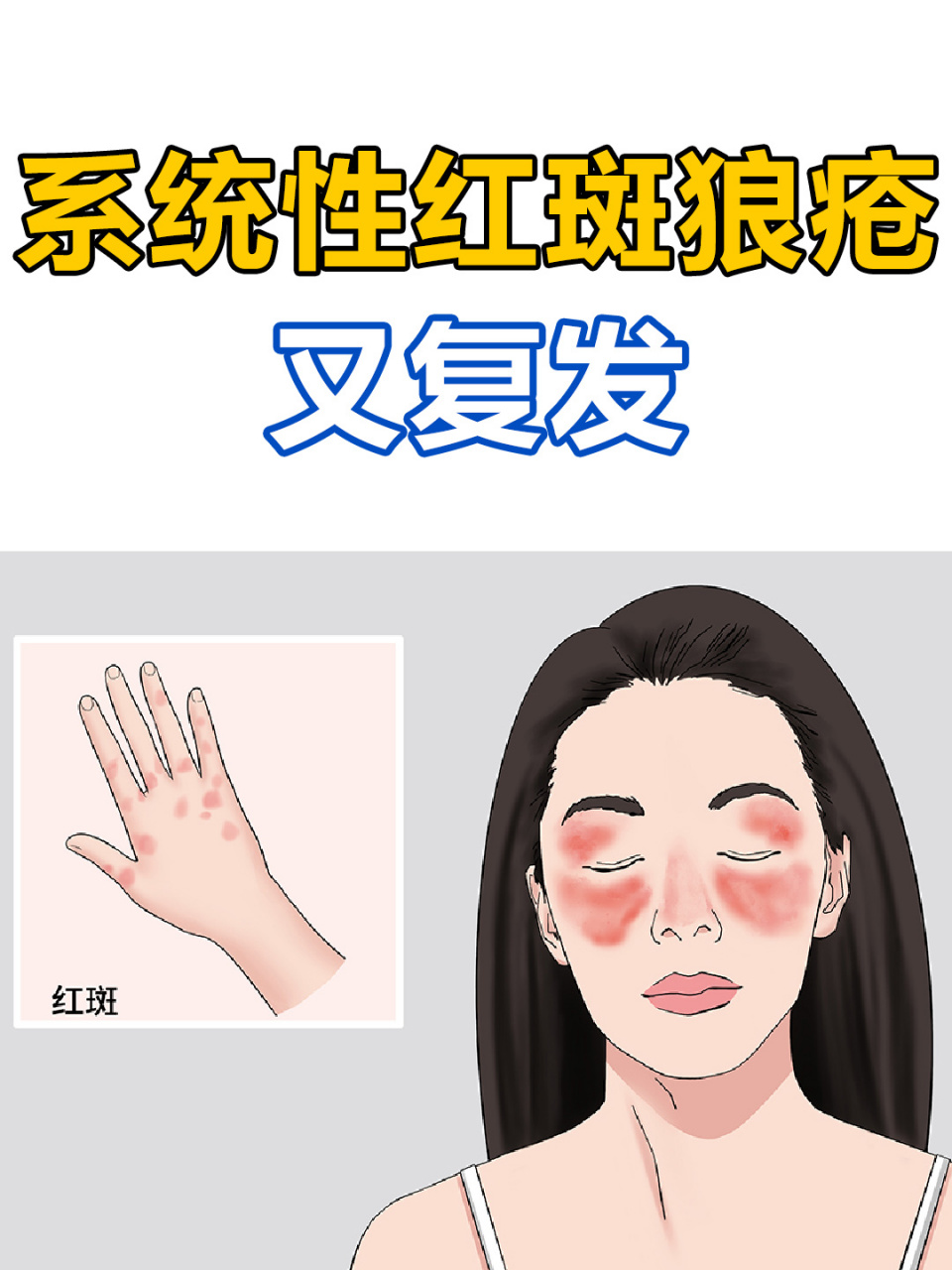 活动期系统性红斑狼疮在经过激素等治疗后,病情通常会趋于缓解,转入
