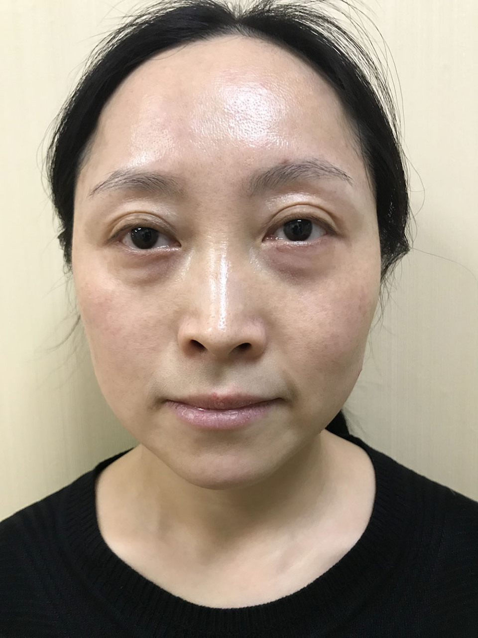 想做眼袋手术,害怕出现凹陷?怎么办?