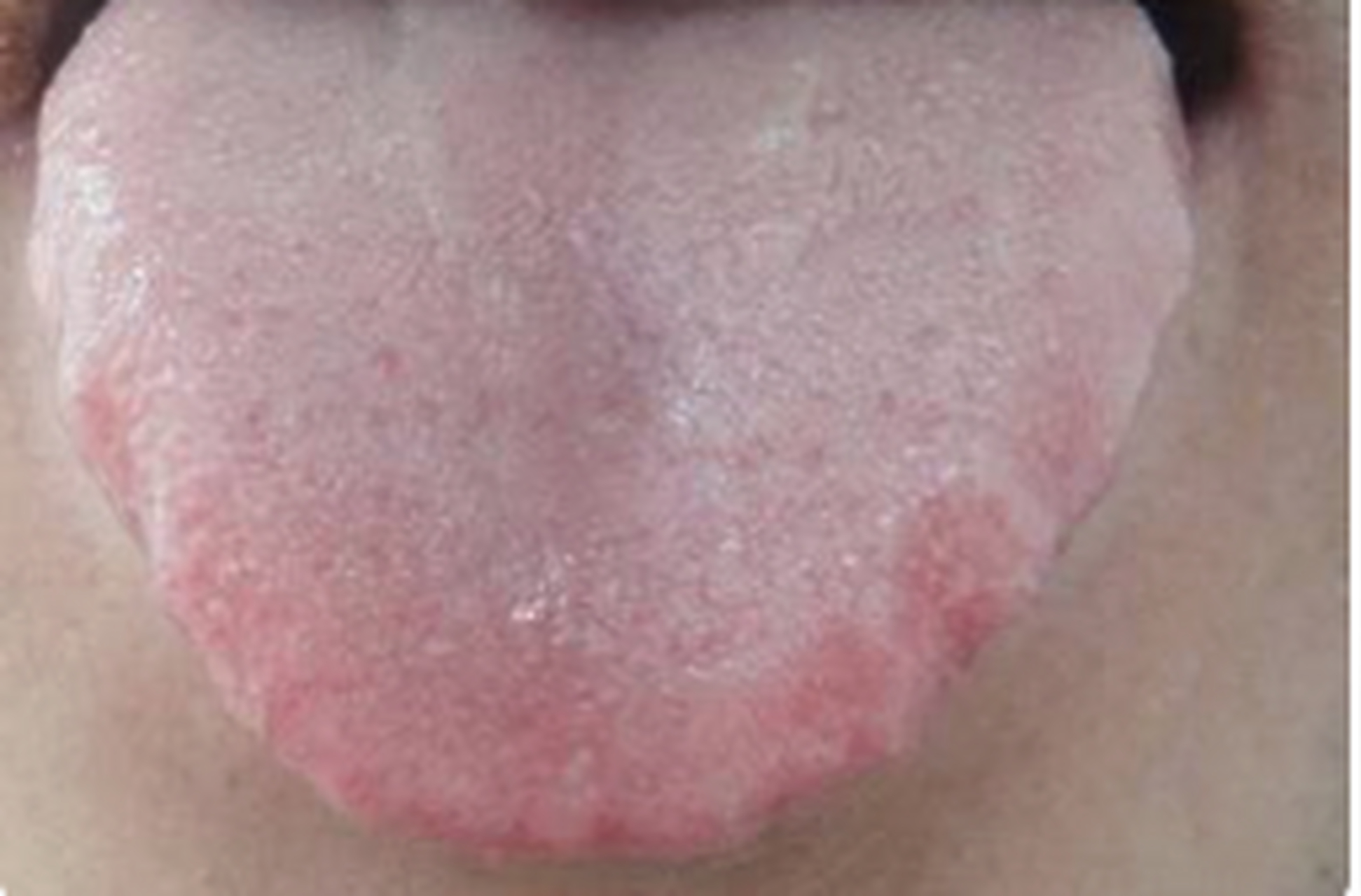 发现舌头有舌齿痕,是怎么回事 舌头突然出现舌齿痕,首先观察我们的