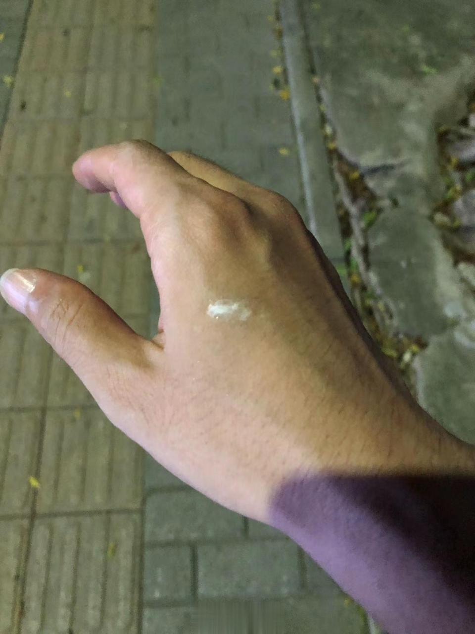 鸟屎拉手上了,怎么办