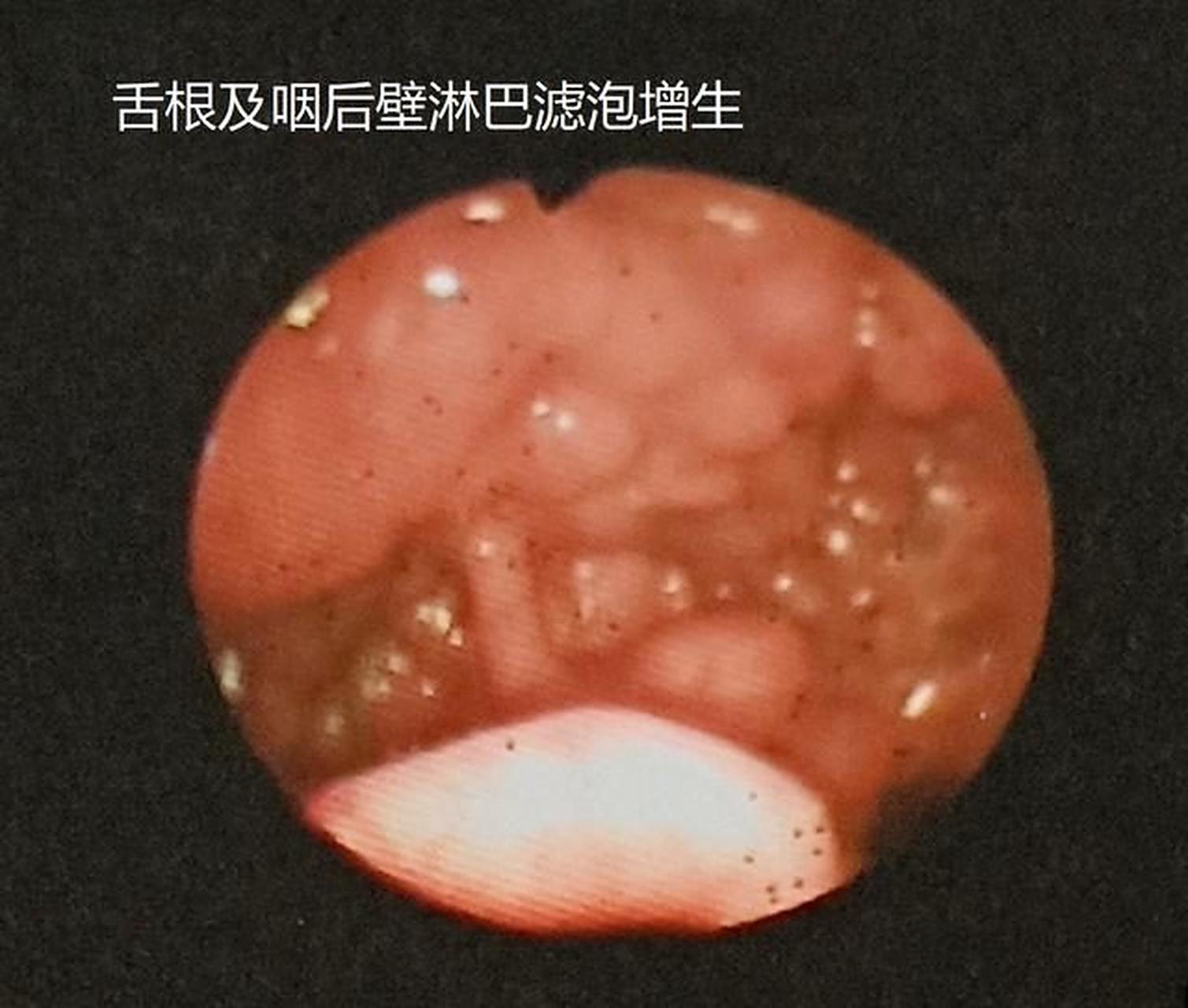 舌根部长滤泡,四种原因对症调理  舌根部滤泡增生,反复不好,通常是没