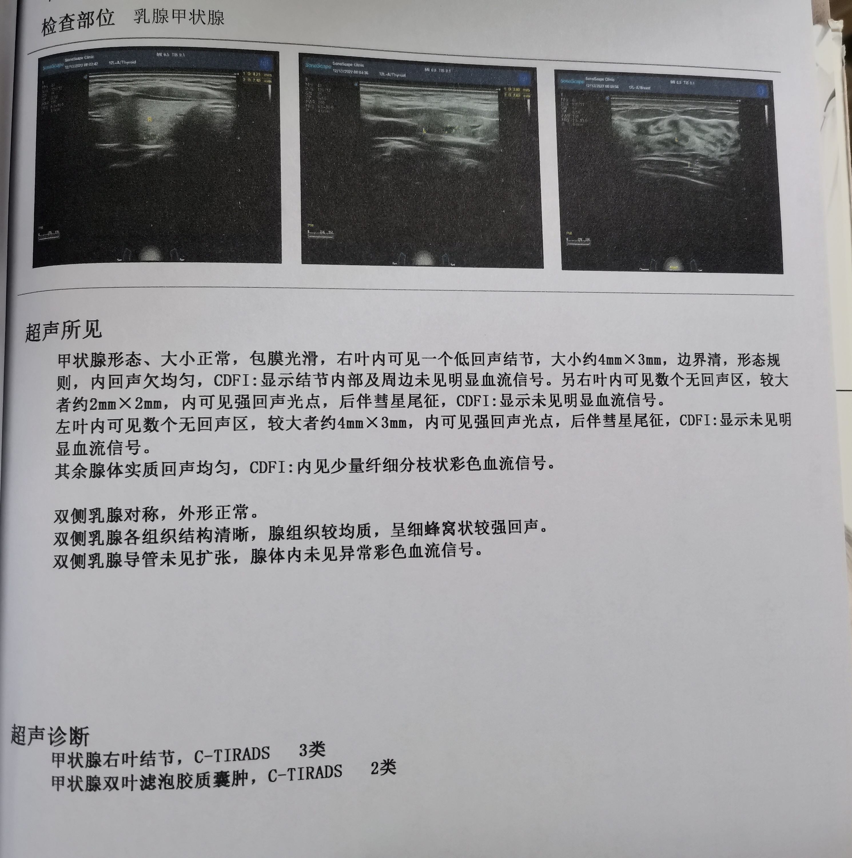 刚查出来甲状腺结节,不能只看大小,报告上这几个关键词也要注意: 1.