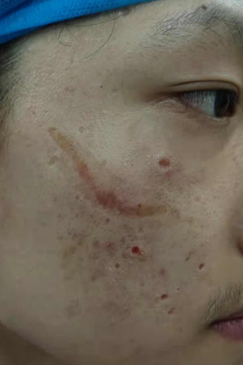 "上初中的时候被霸凌过,右脸被被霸凌者划伤了.