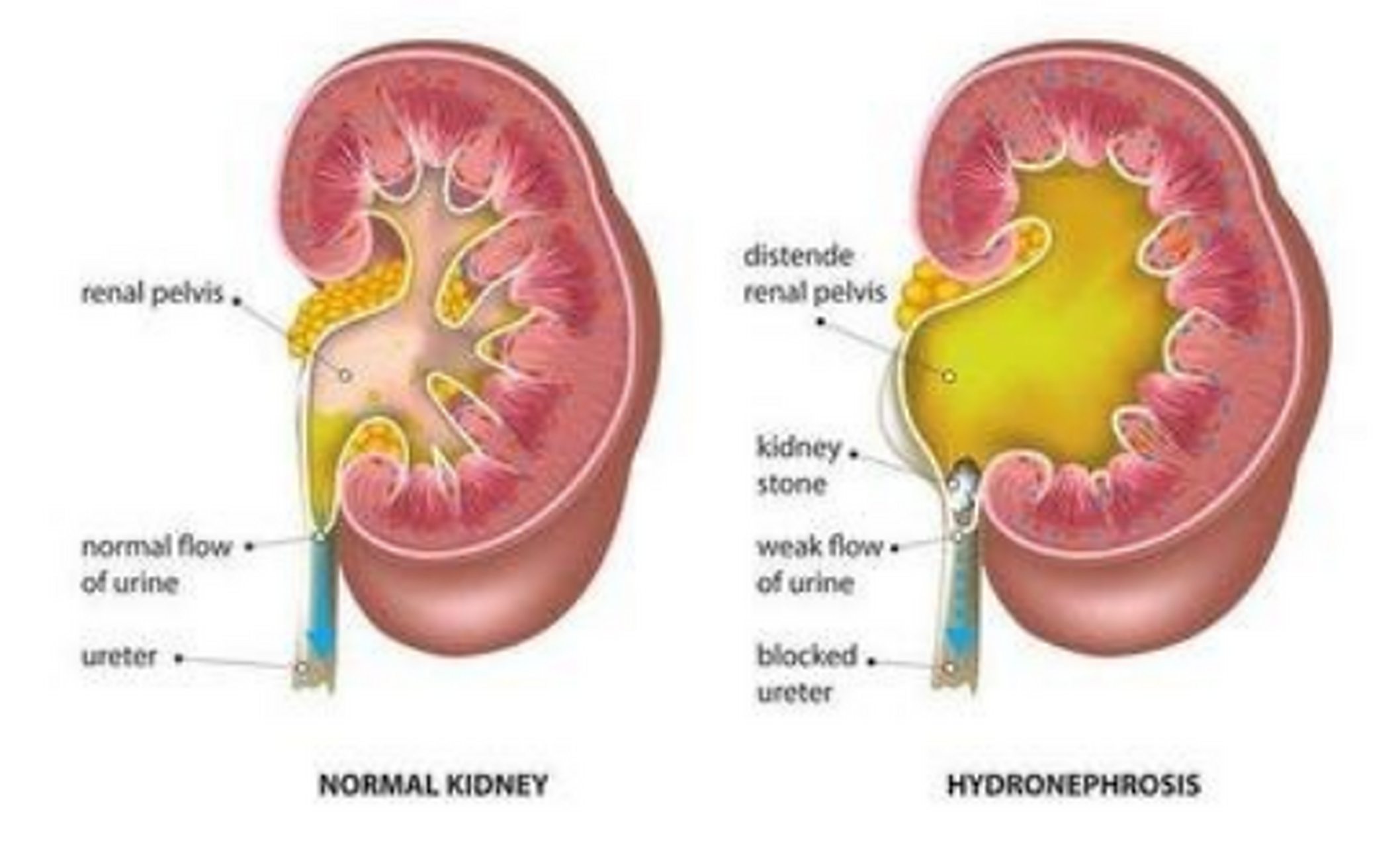 肾结石排石方法介绍:1,药物排石:适用于结石直径小于6mm,并且光滑者