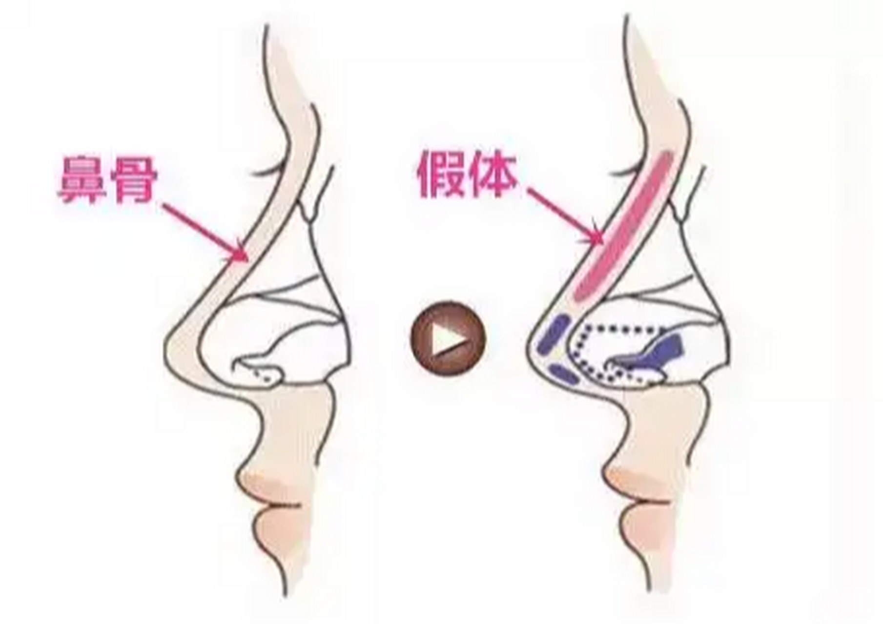 隆鼻后假体外露图片