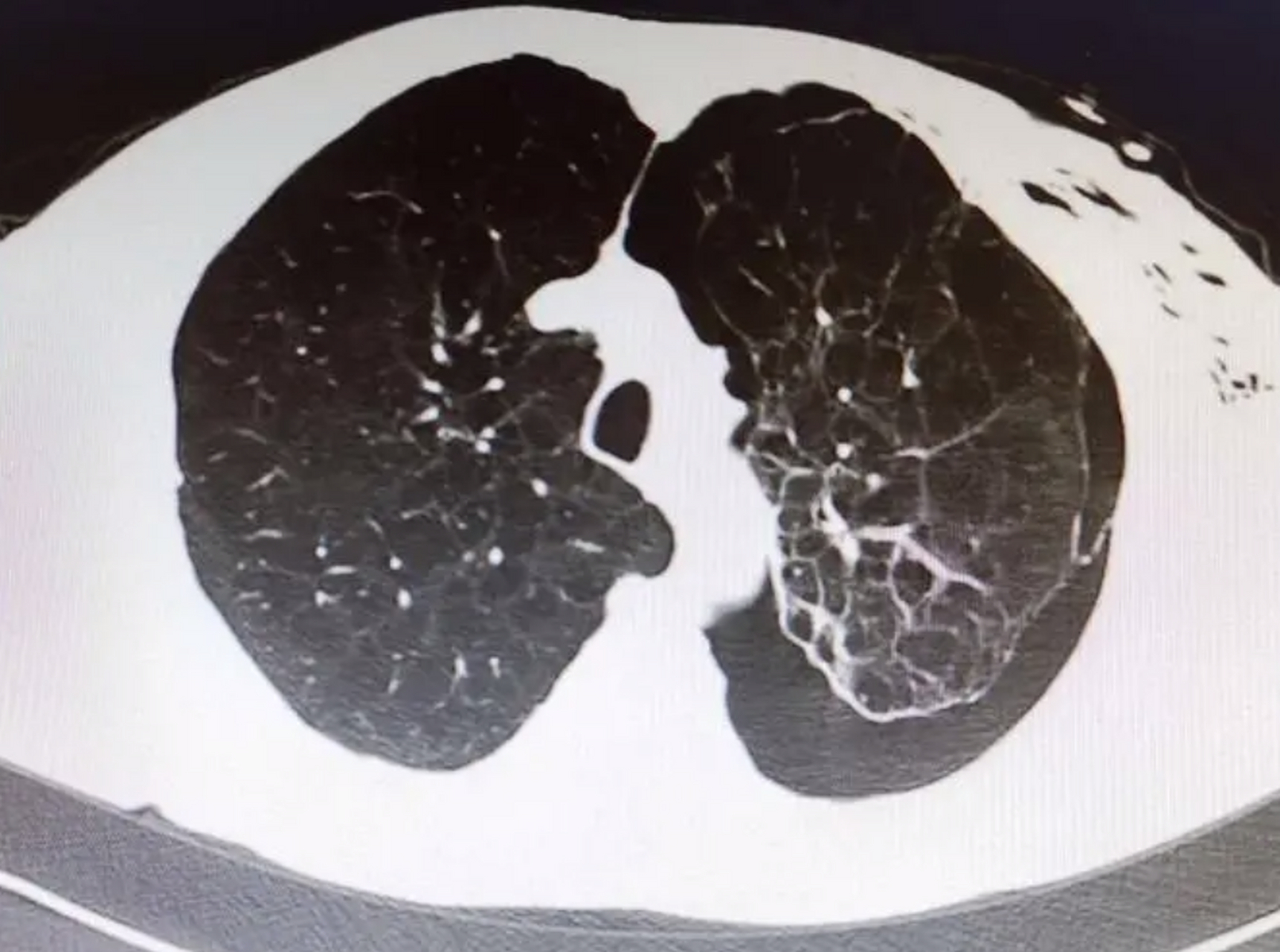 体检查出来9mm肺大泡,对我们身体的危害大吗?