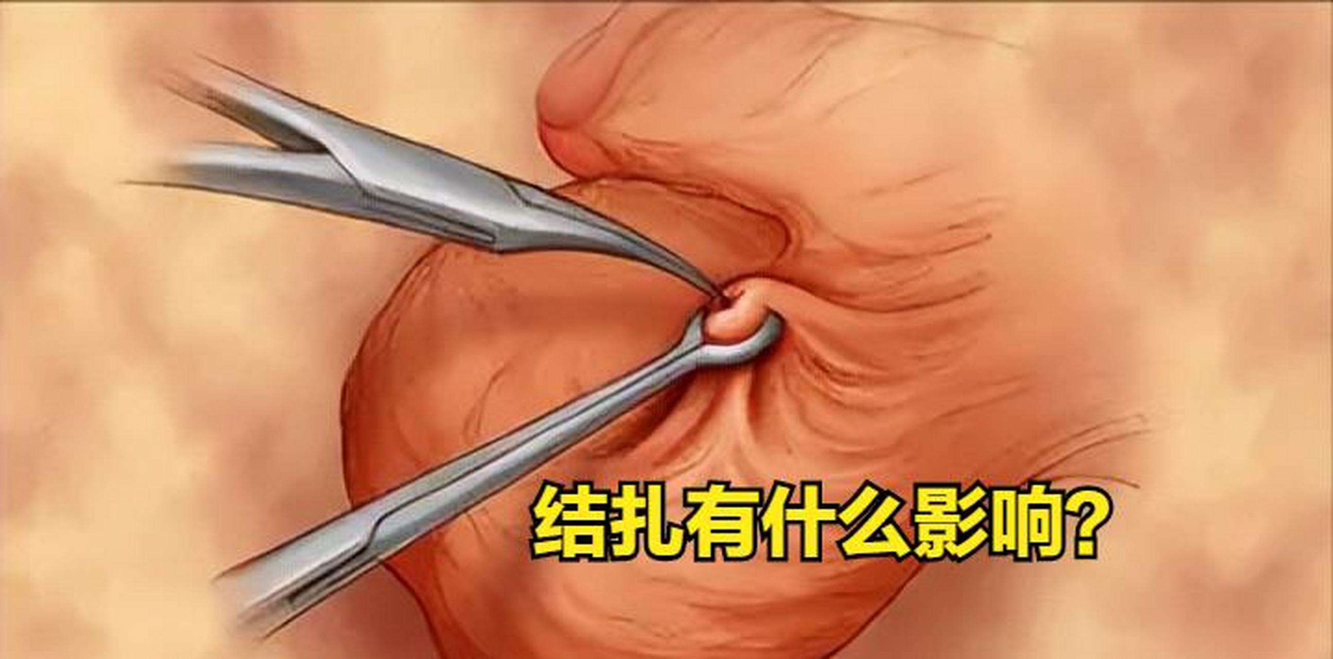 "男性做结扎手术对身体有什么影响吗?