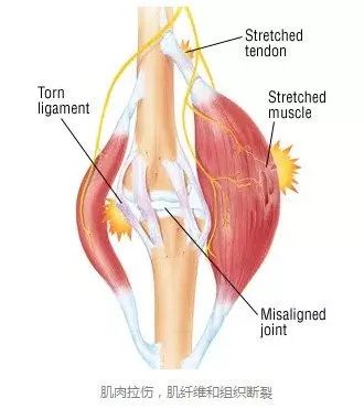冈上肌肌腱撕裂是否可以自愈 冈上肌肌腱撕裂能否自愈,主要取决于肌腱