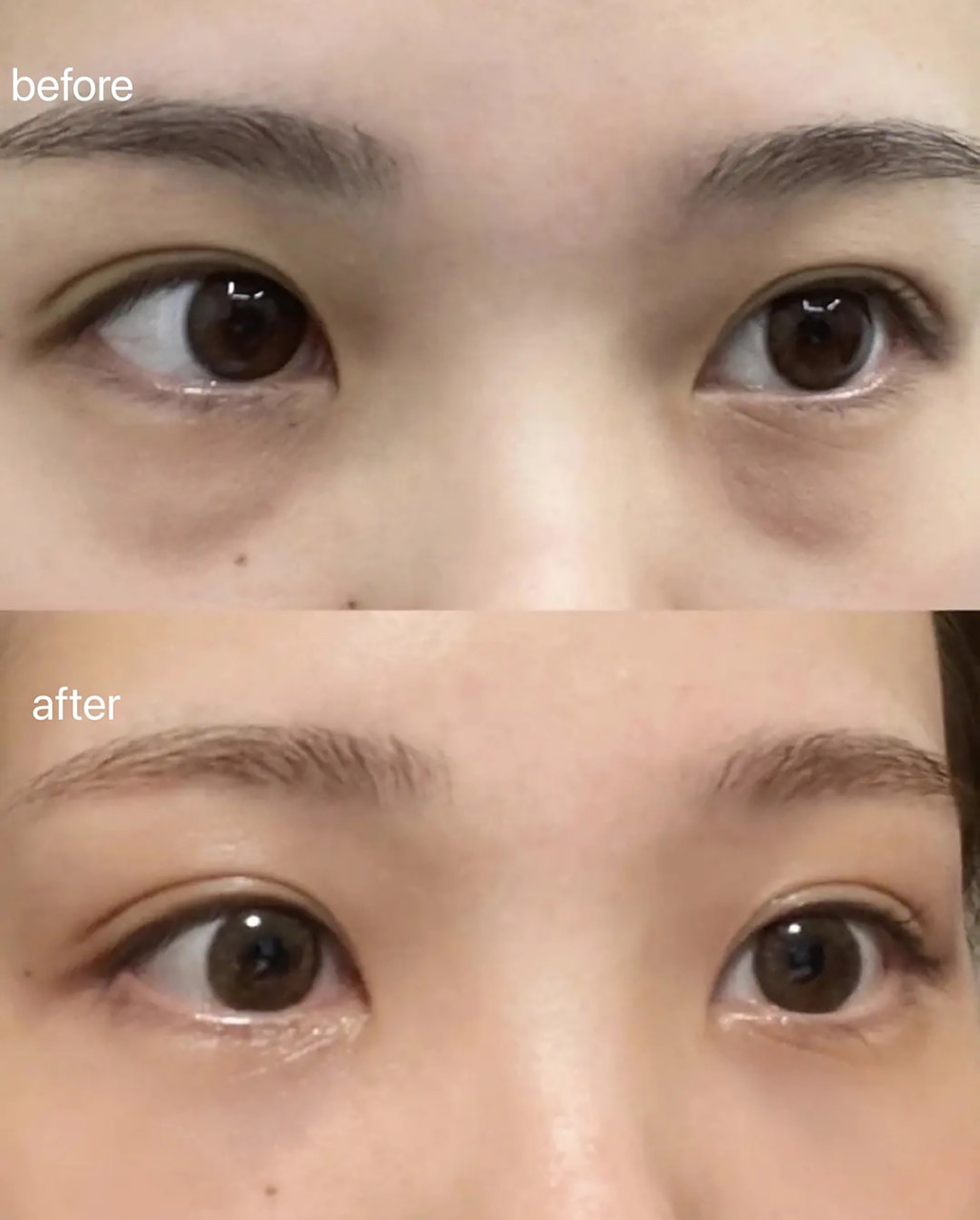 泪沟与眼袋的区别图  眼袋: 眼袋位于距下眼皮2-3cm的地方.