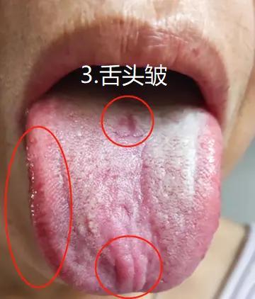 舌诊辩证——肝郁舌象 气机失调:这样的舌象多在舌前段会有凸起或者
