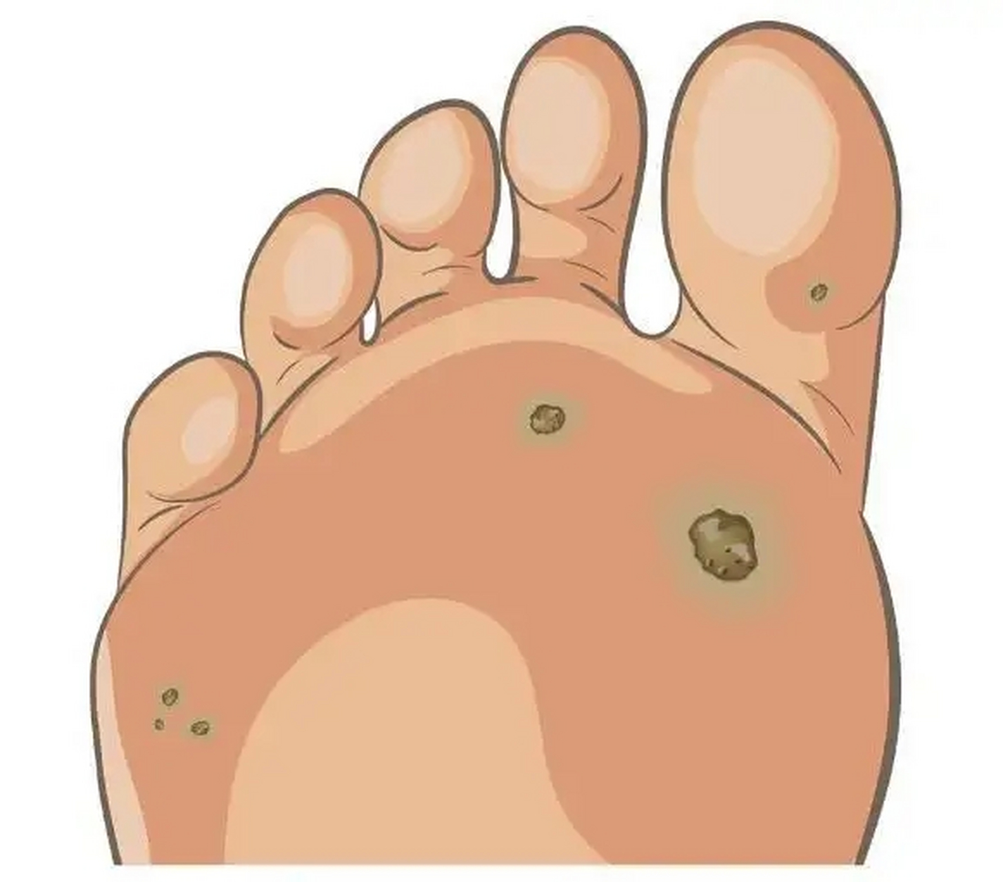 跖疣是由人乳头病毒(hpv)感染引起的一种常见的皮肤感染,它通常在足底