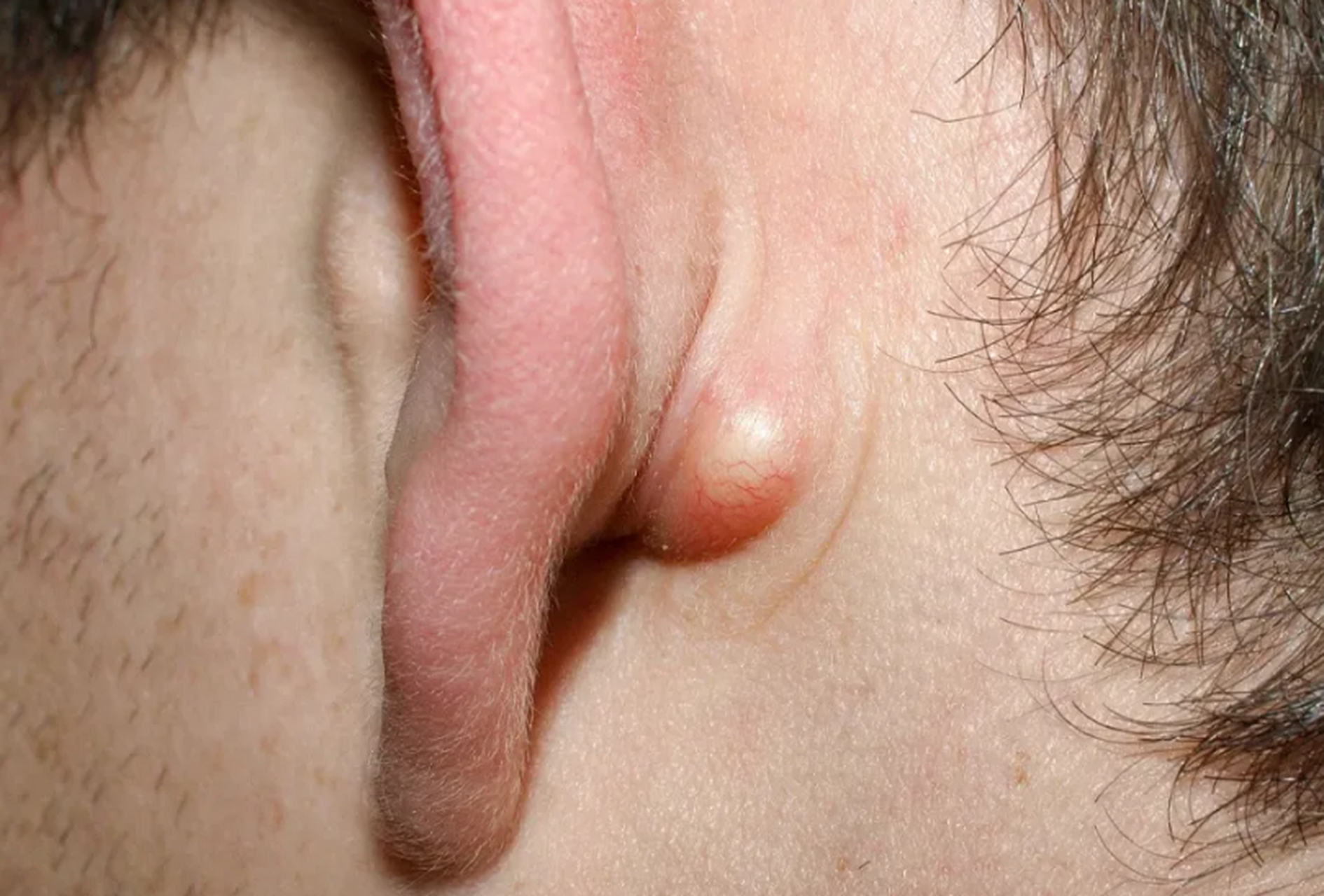 比如一些简单的表皮囊肿,当囊内分泌物的产生和囊壁的增厚达到平衡