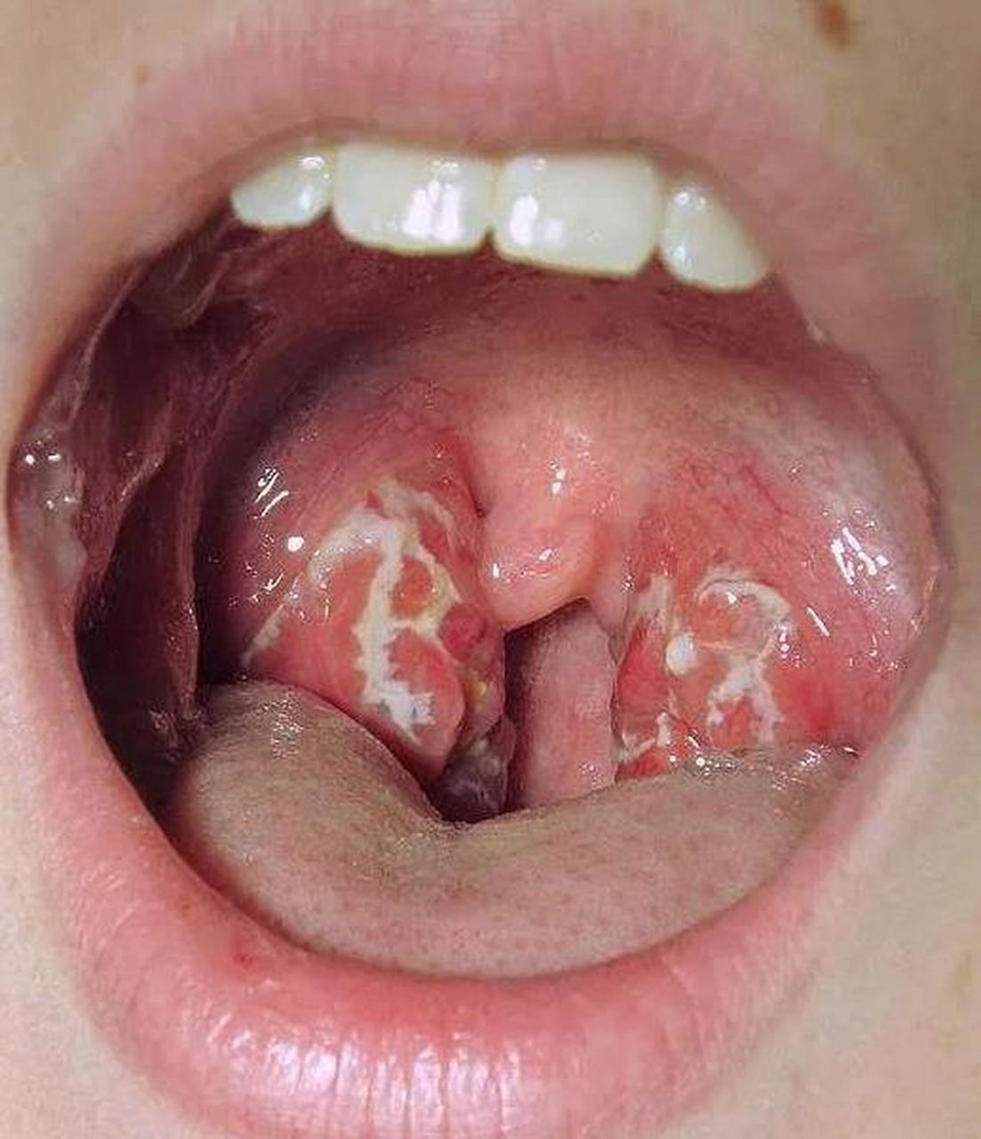 患儿家长自述: 孩子从小扁桃体都比较肿大,到6岁左右发现晚上睡觉呼噜