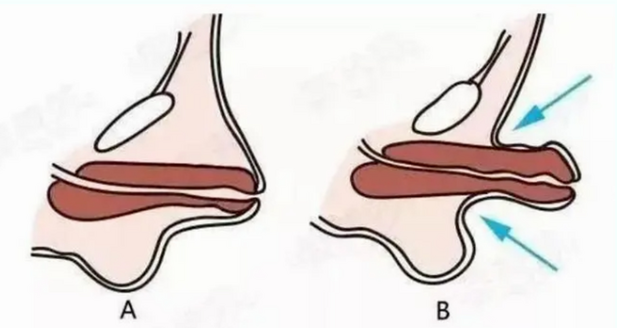 隐匿阴茎的病因包含有肉膜发育不良和阴茎皮肤与阴茎体固定不牢,阴茎