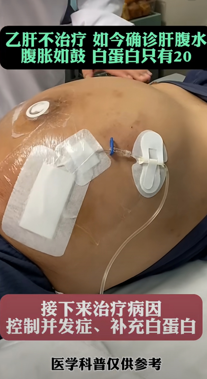 肝腹水怎样治疗比较好? 1.需要卧床休息治疗,这是非常关键的. 2.