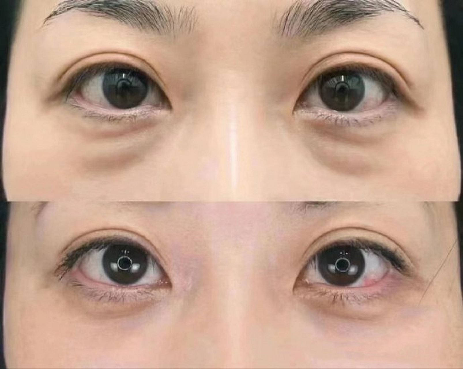 祛眼袋真的是眼周抗衰效果,性价比第一!