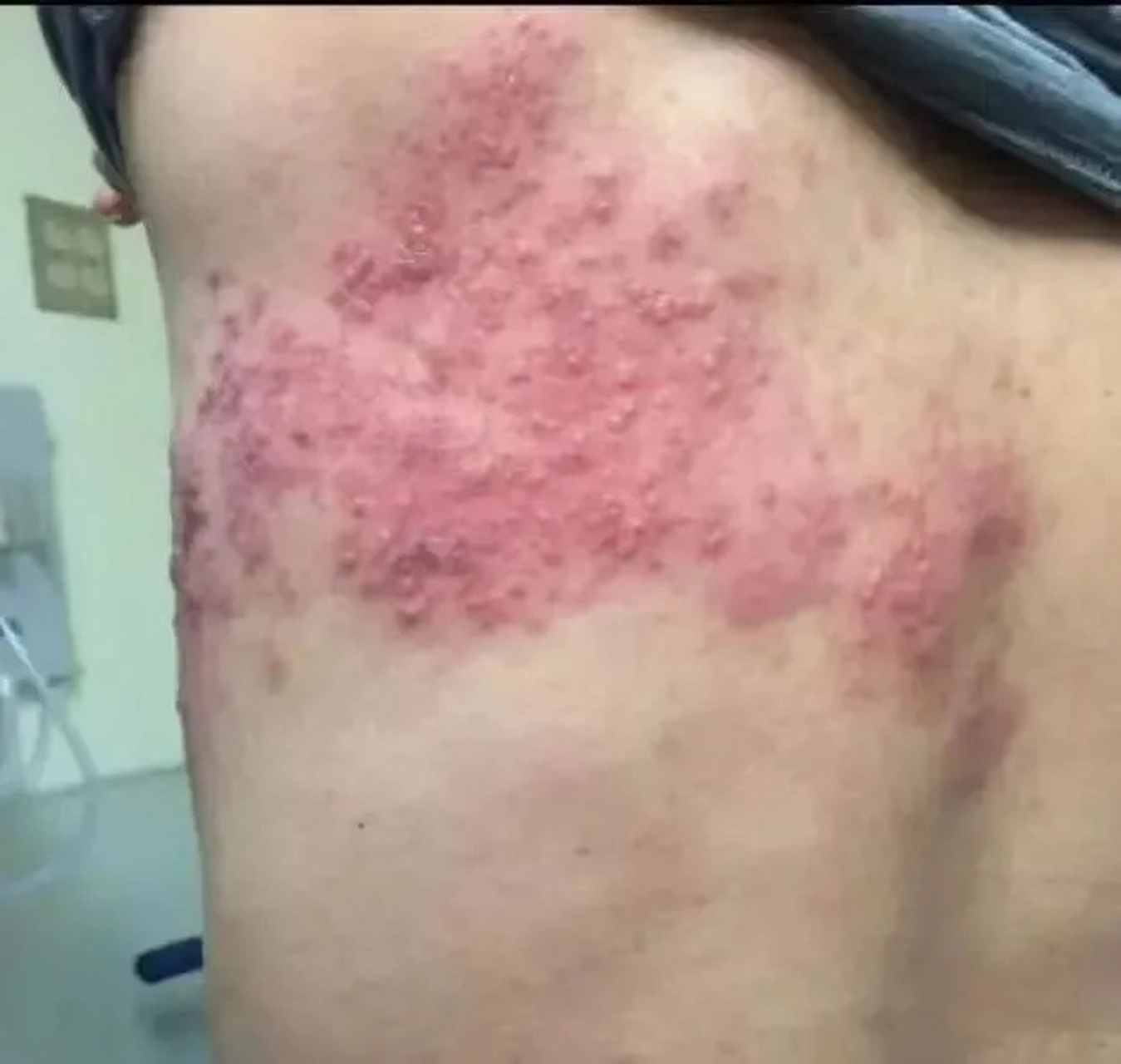 水痘和带状疱疹是同一个病毒所引起的,如果在儿童时期感染,得的就是