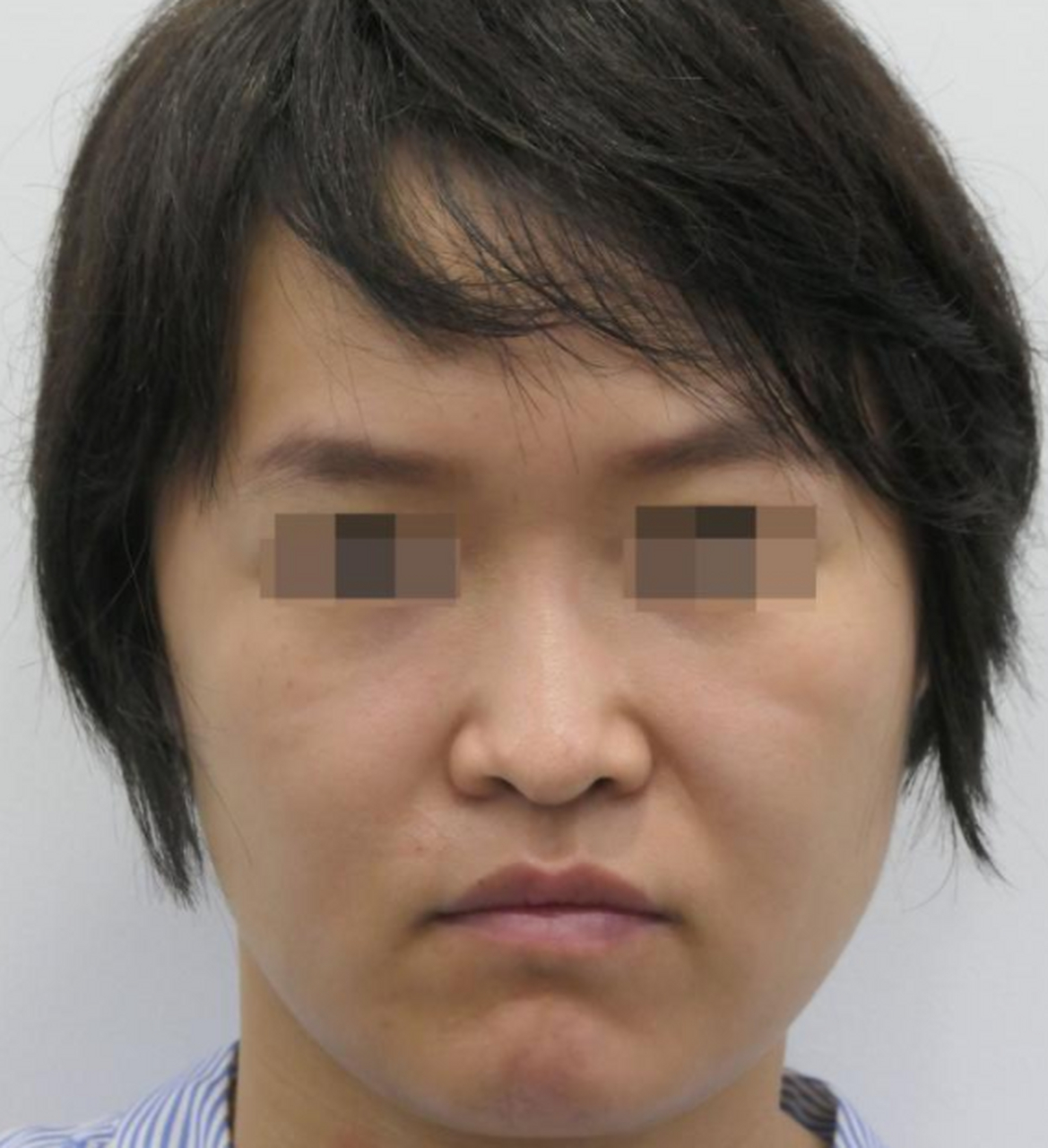 下图这位姑娘法令纹深,鼻基底凹陷,十分显老,来看看是怎么通过#膨体